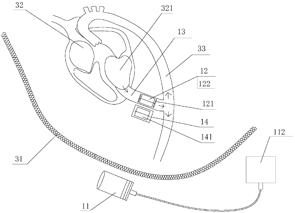 Exocardial assisted-circulation artificial heart