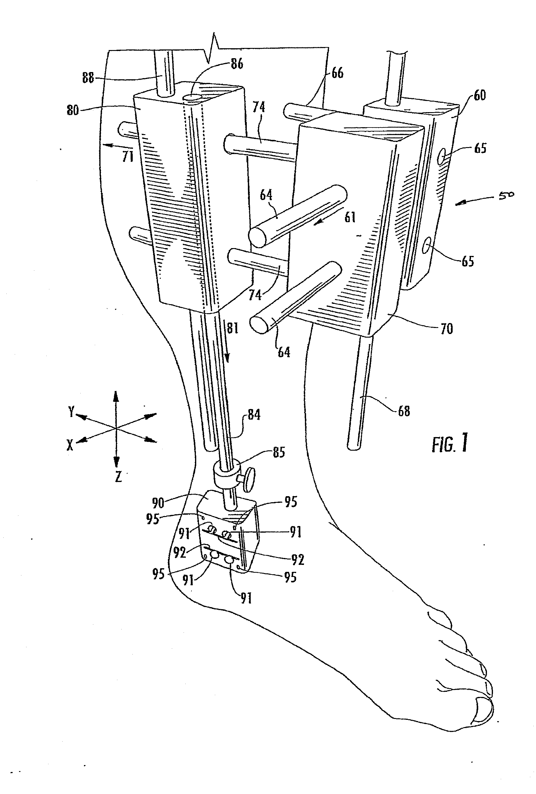 Method of Preparing an Ankle Joint for Replacement, Joint Prosthesis, and Cutting Alignmnet Apparatus for Use in Performing an Arthroplasty Procedure