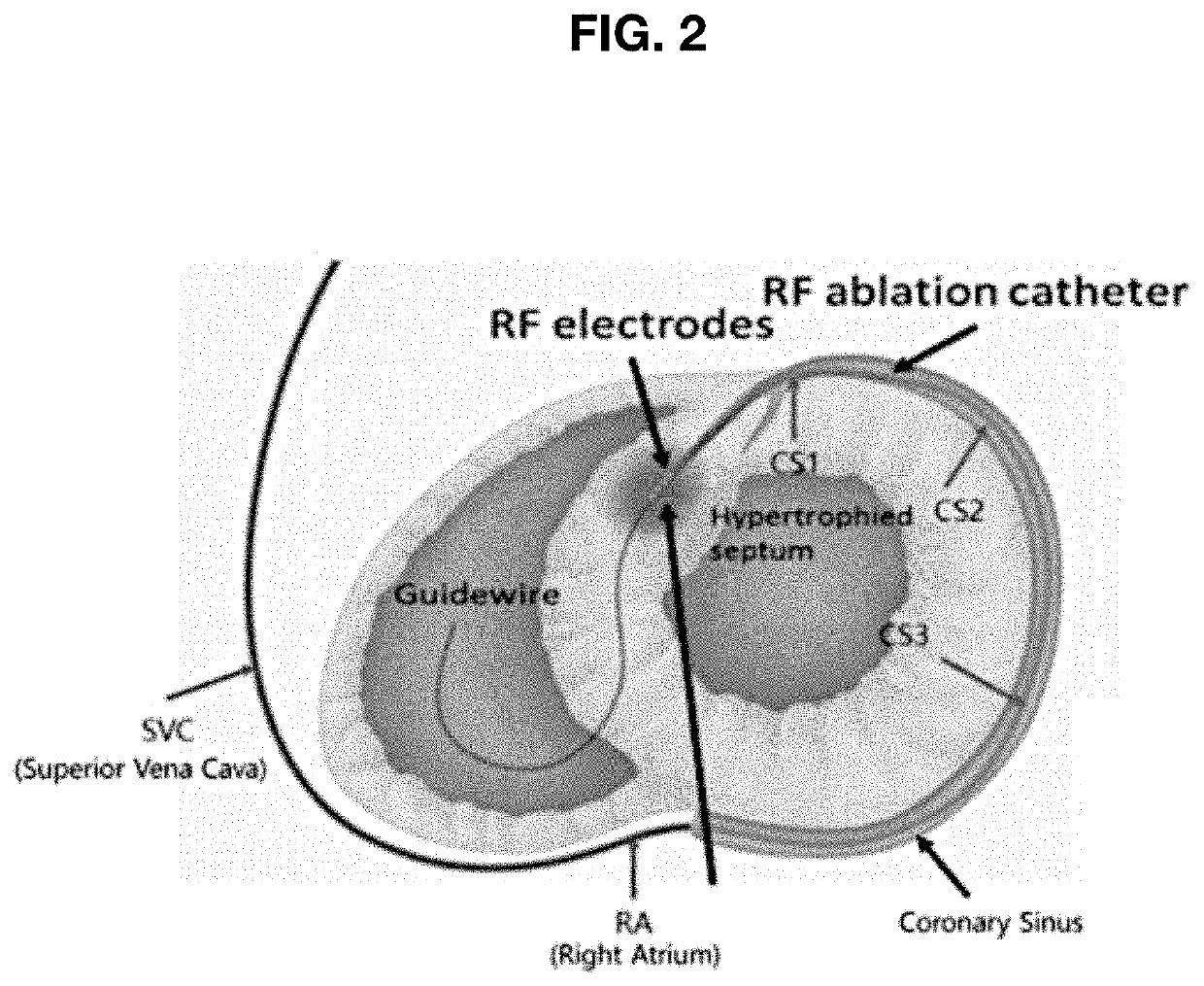 RF ablation catheter for septal reduction therapy having cooling effect