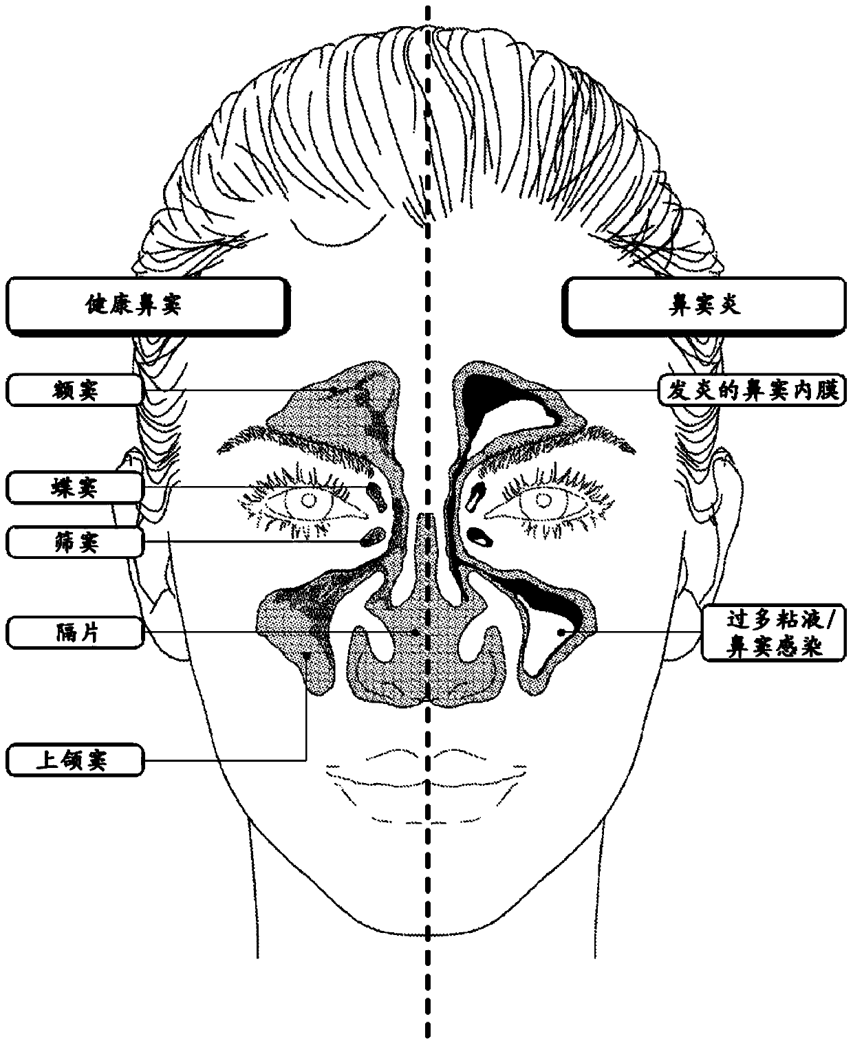 Devices and methods for diagnosis of sinusitis