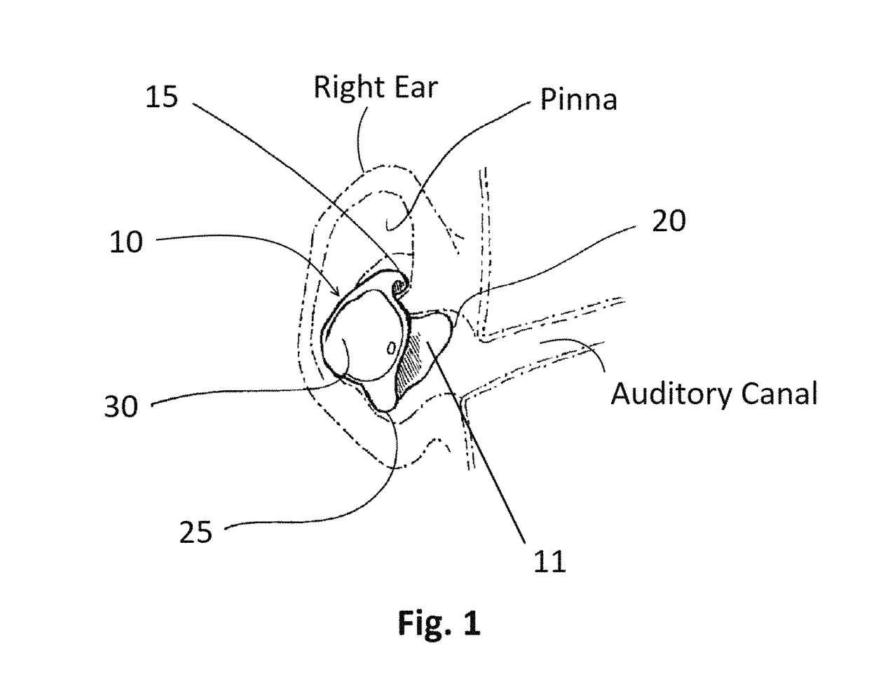 Sound system with ear device with improved fit and sound