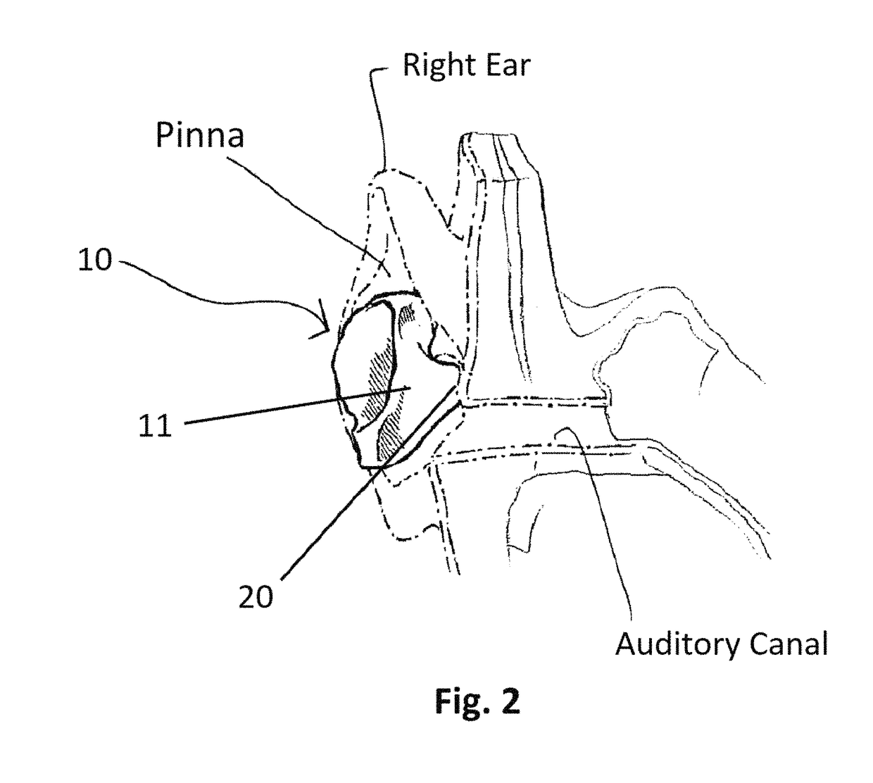 Sound system with ear device with improved fit and sound