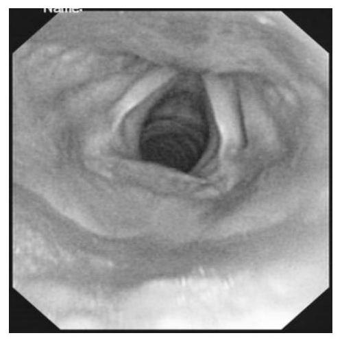 An attention mechanism-based method for marking lesions in optical laryngoscope images