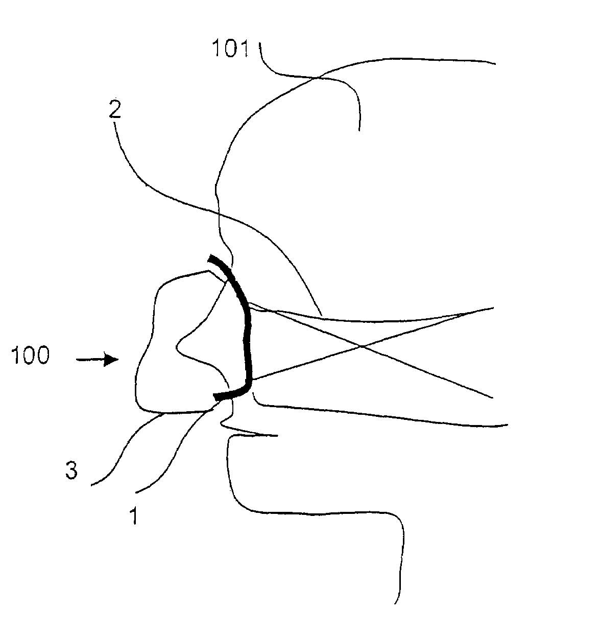 Breathing mask with individual adaptation to the shape of the face