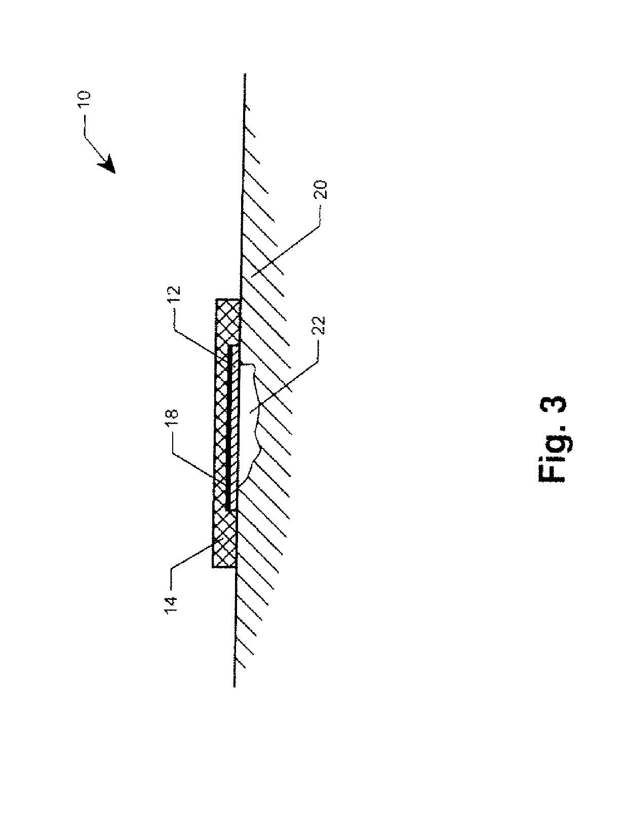 Device and method for healing wounds