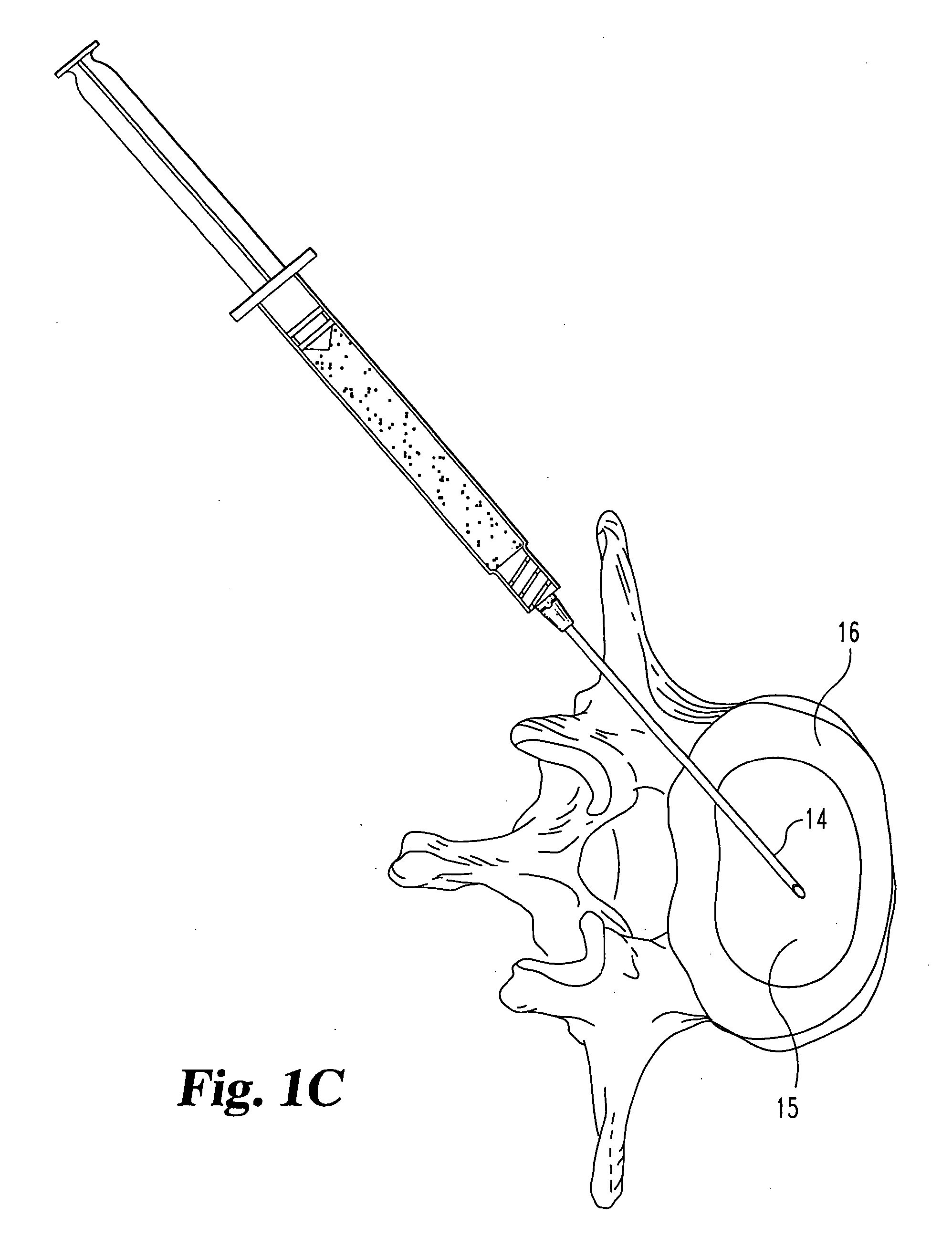 Collagen-based materials and methods for augmenting intervertebral discs