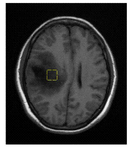 Method for detecting P53 protein expression in brain tumor