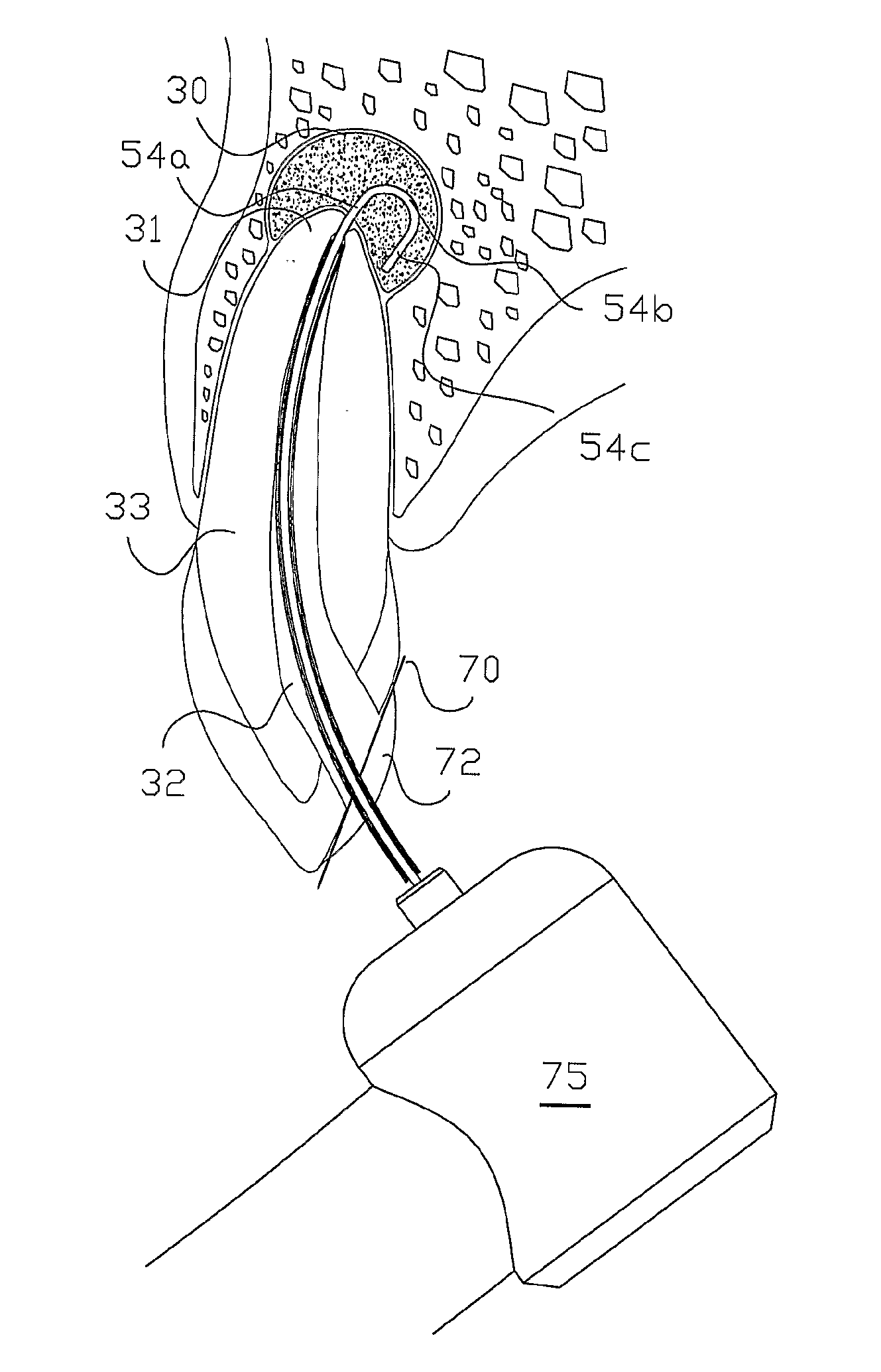 Method of Treating Dental Periapical Lesions