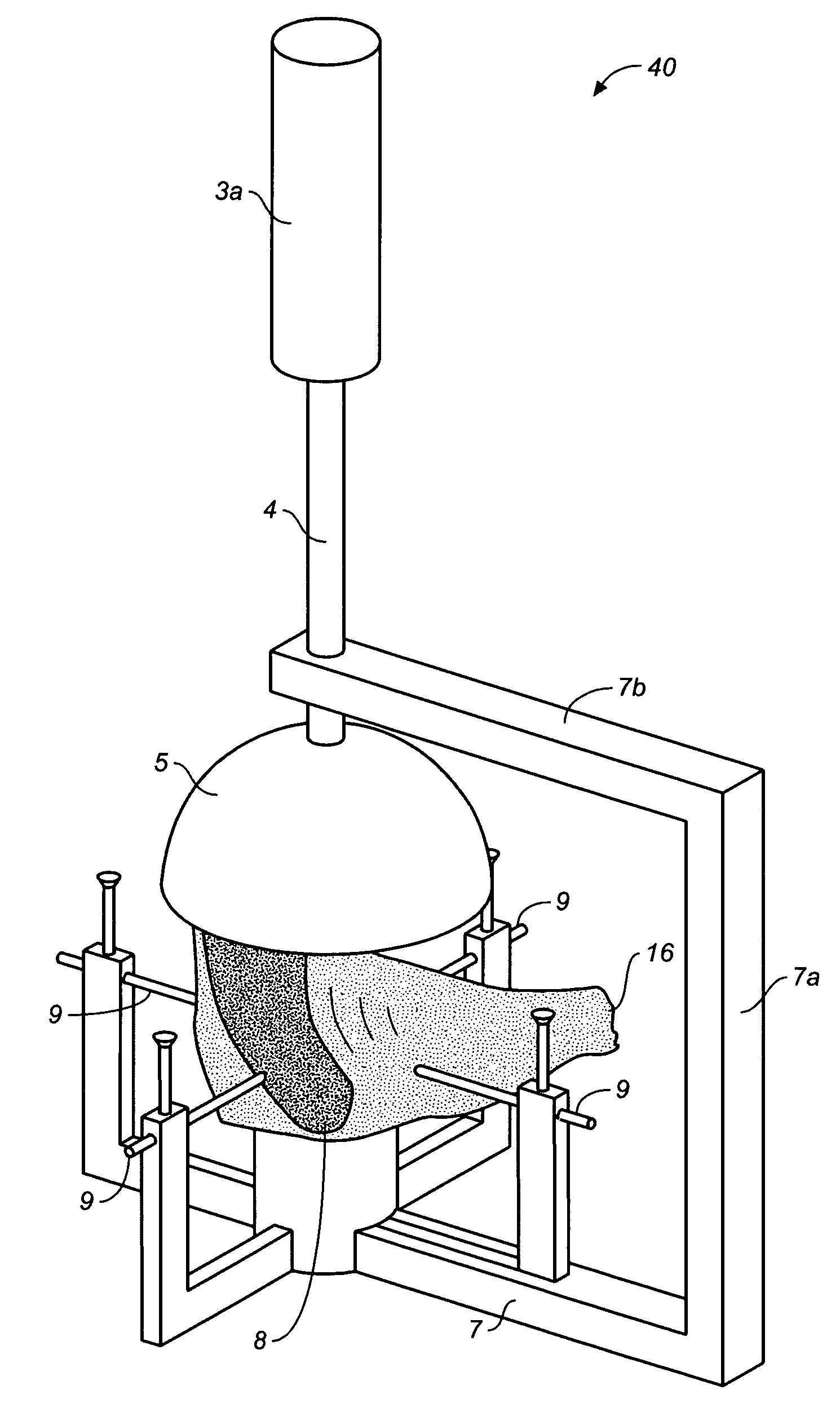 Device and method for allograft total hip arthroplasty