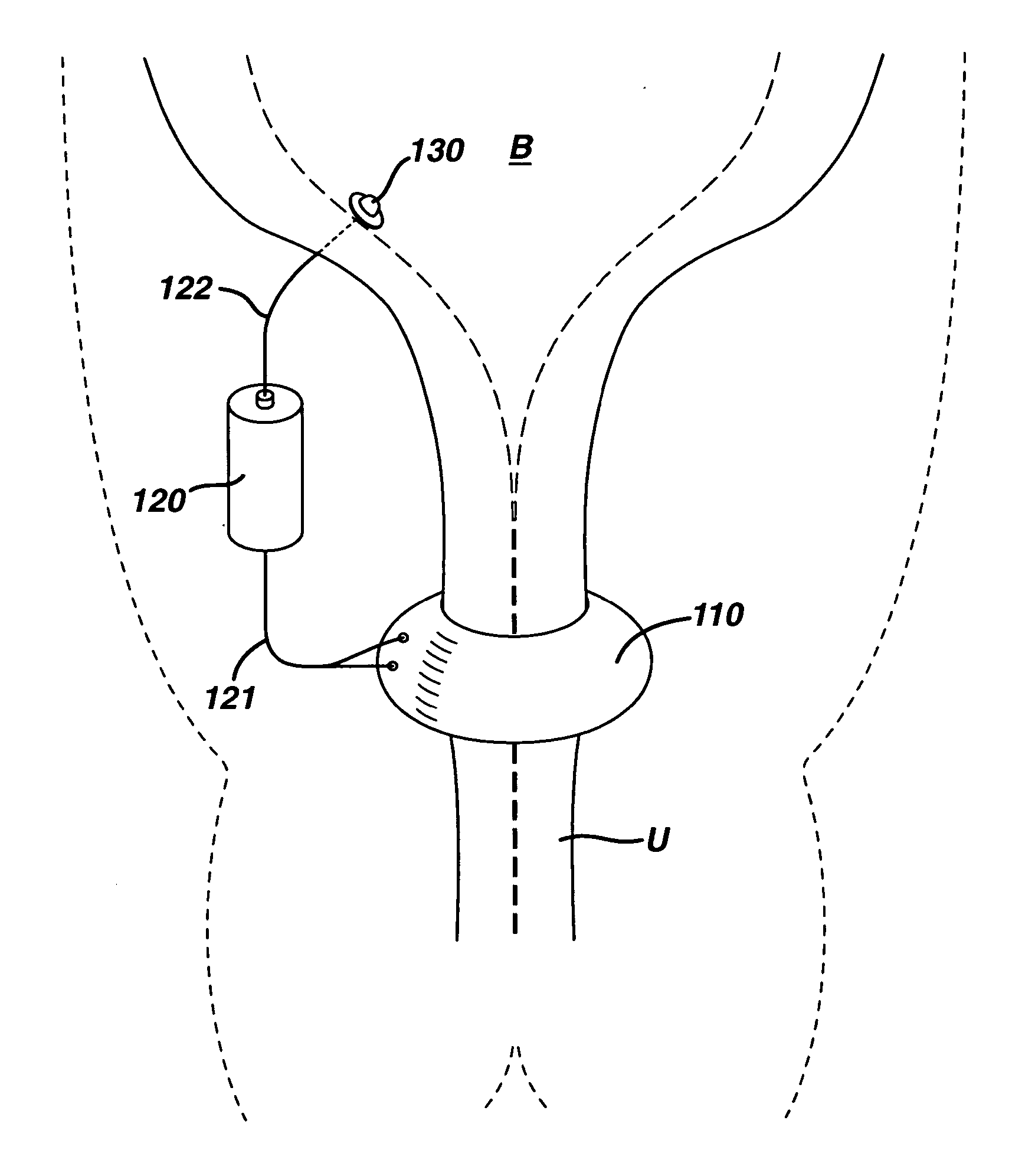 Artificial sphincter with variable viscosity fluid-filled collar