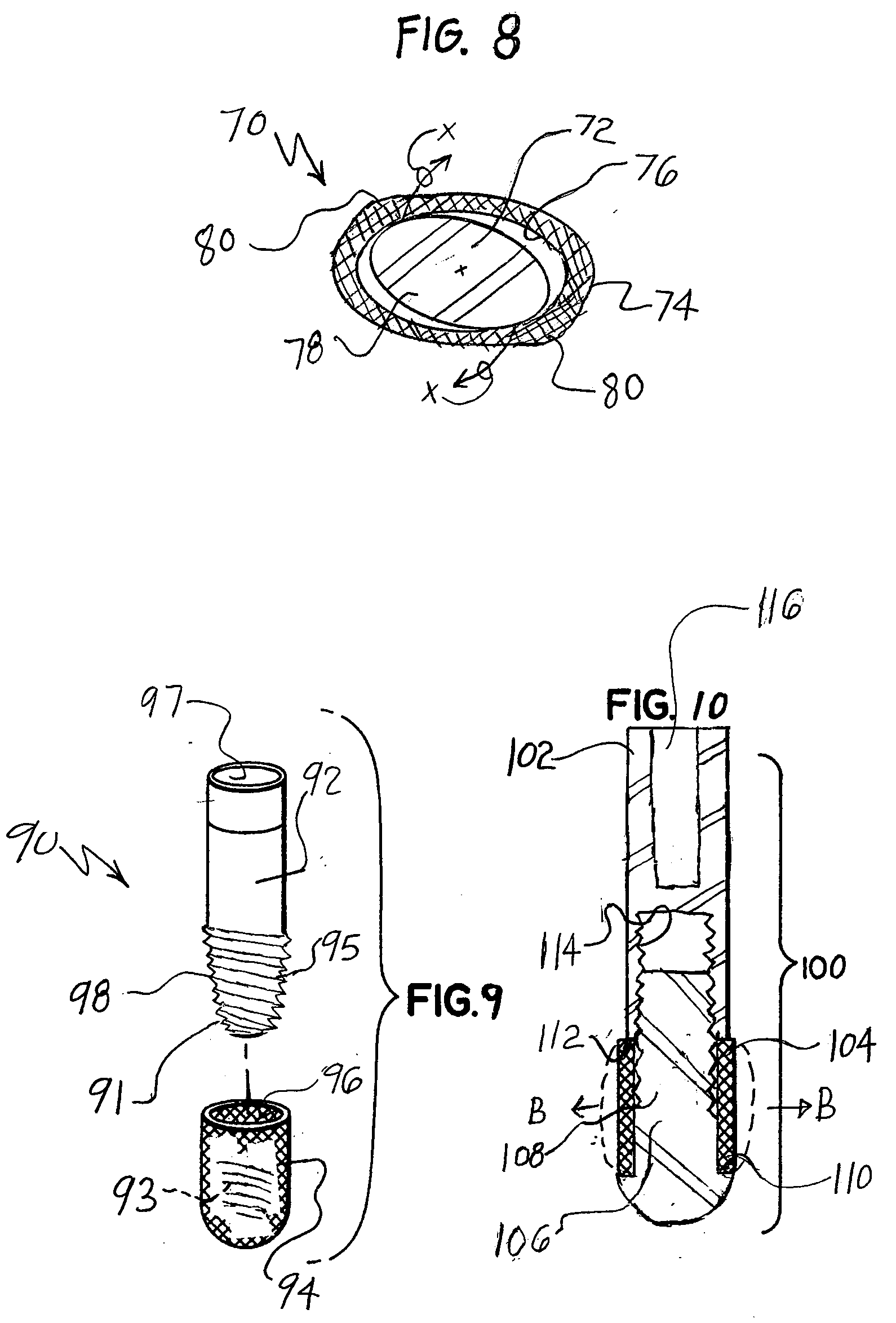 Expandable bone implant