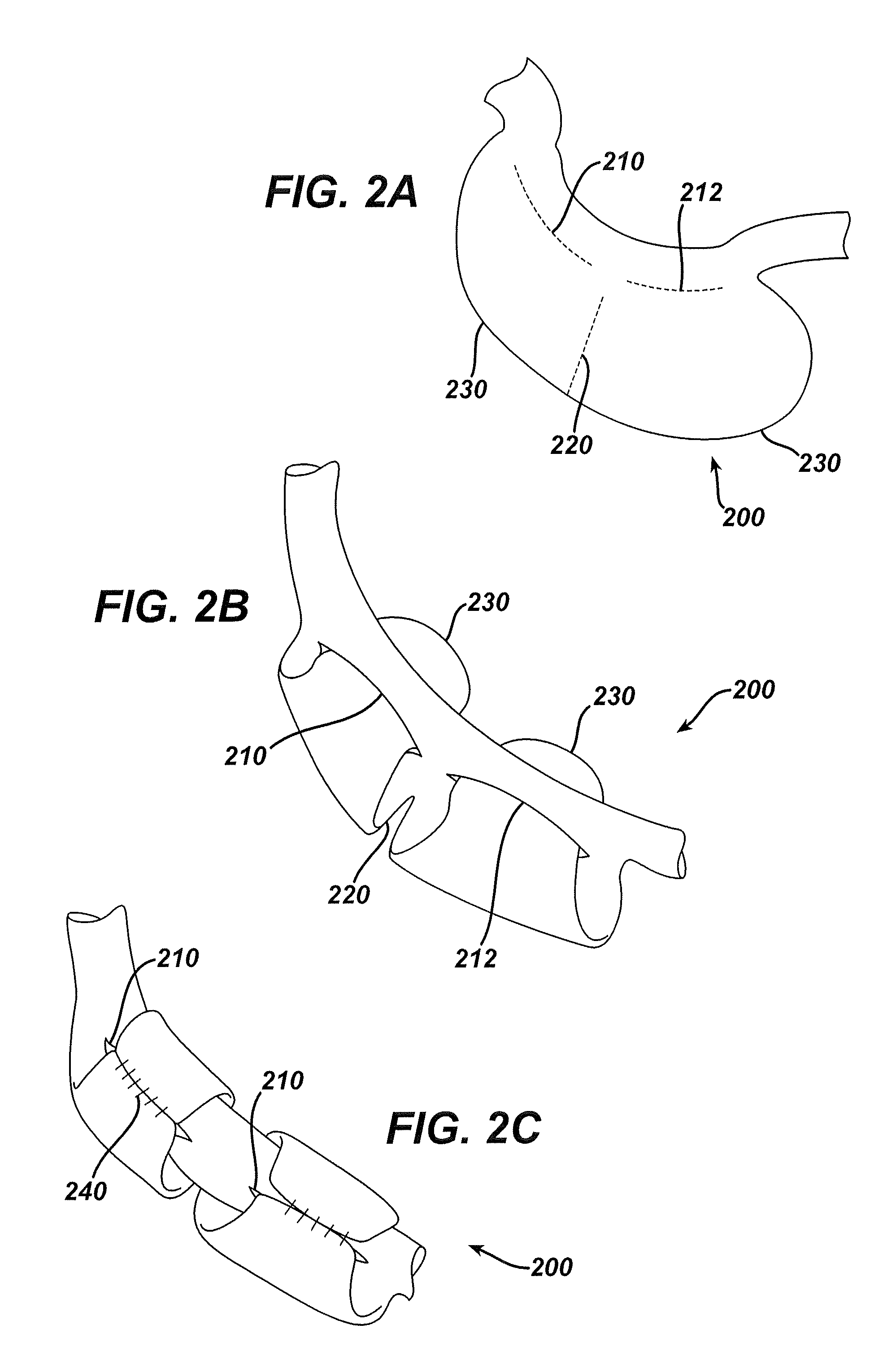 Systems and methods for gastric volume regulation