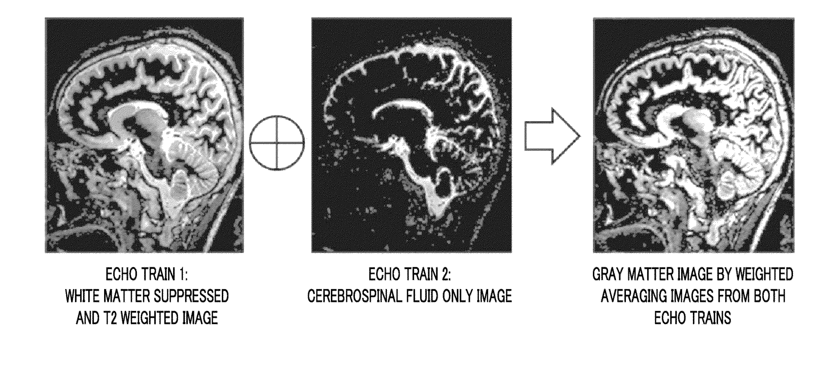 Magnetic resonance imaging apparatus capable of acquiring selective gray matter image, and magnetic resonance image using same