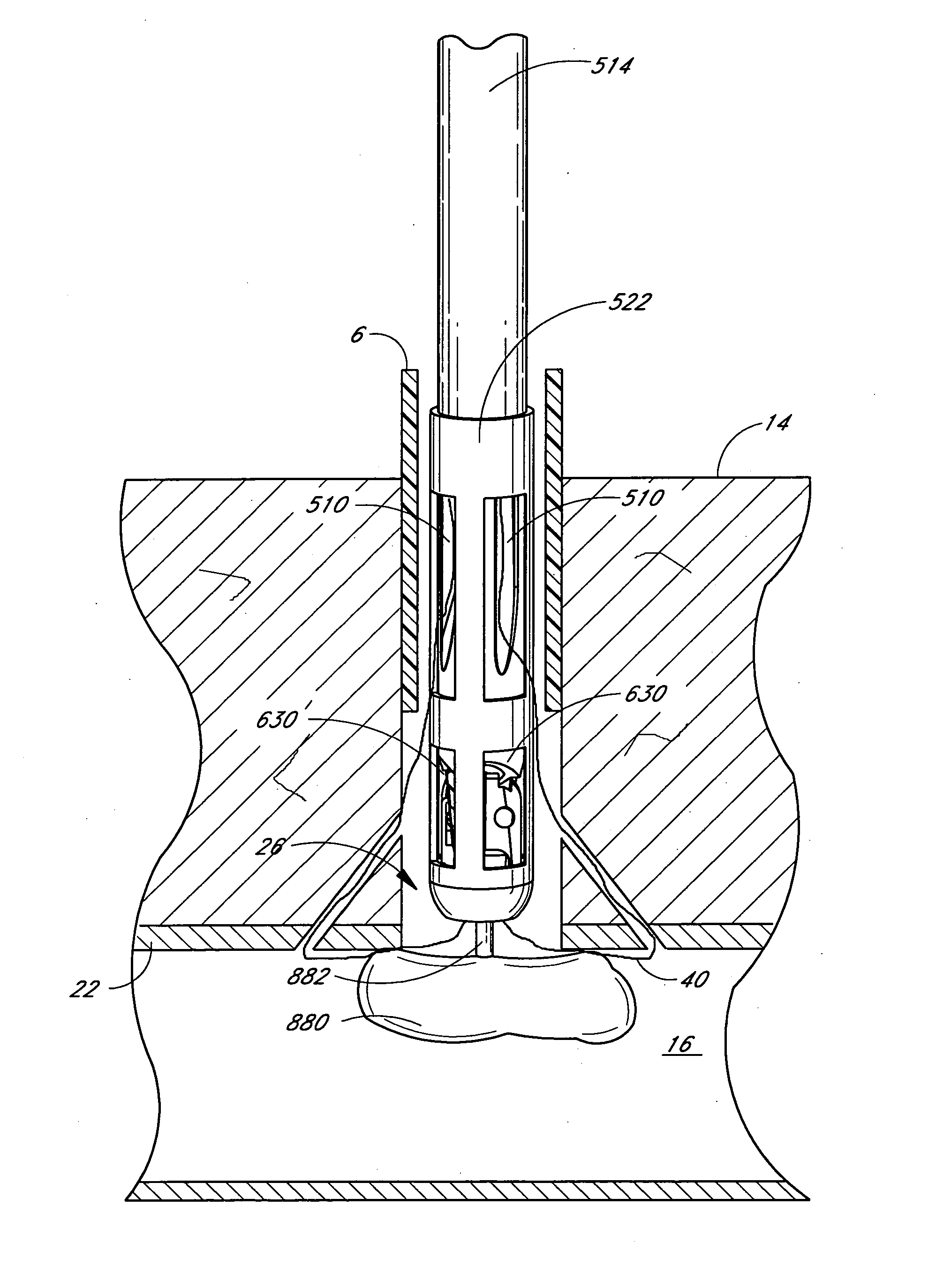 Suturing device and method
