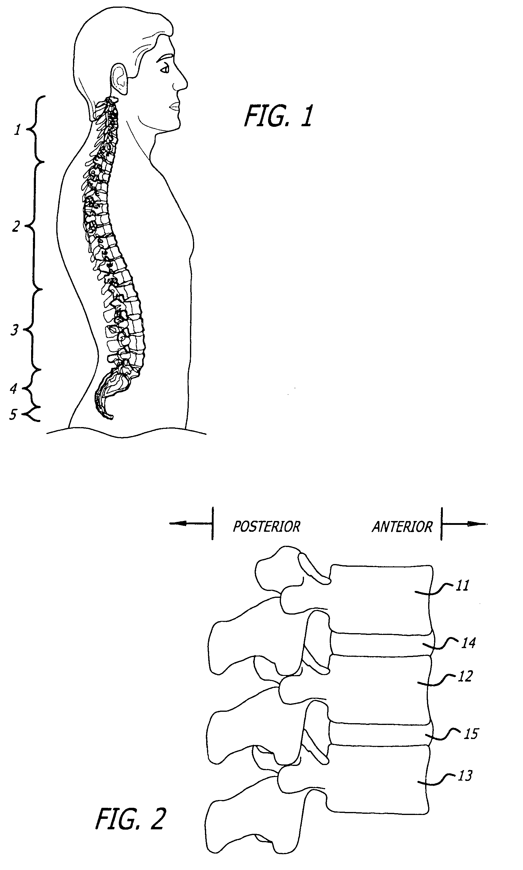 Prosthetic spinal discs