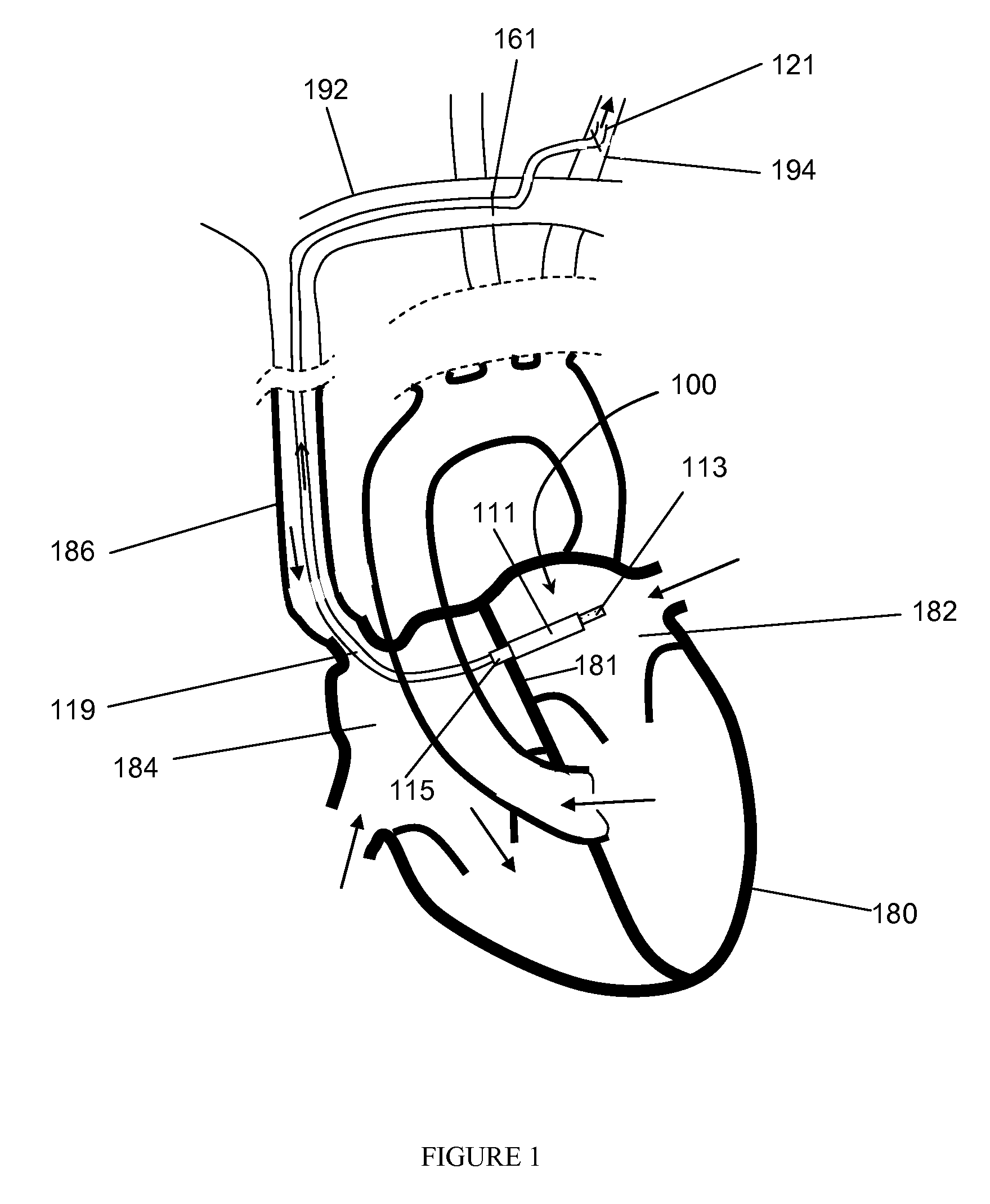 Intraatrial ventricular assist device