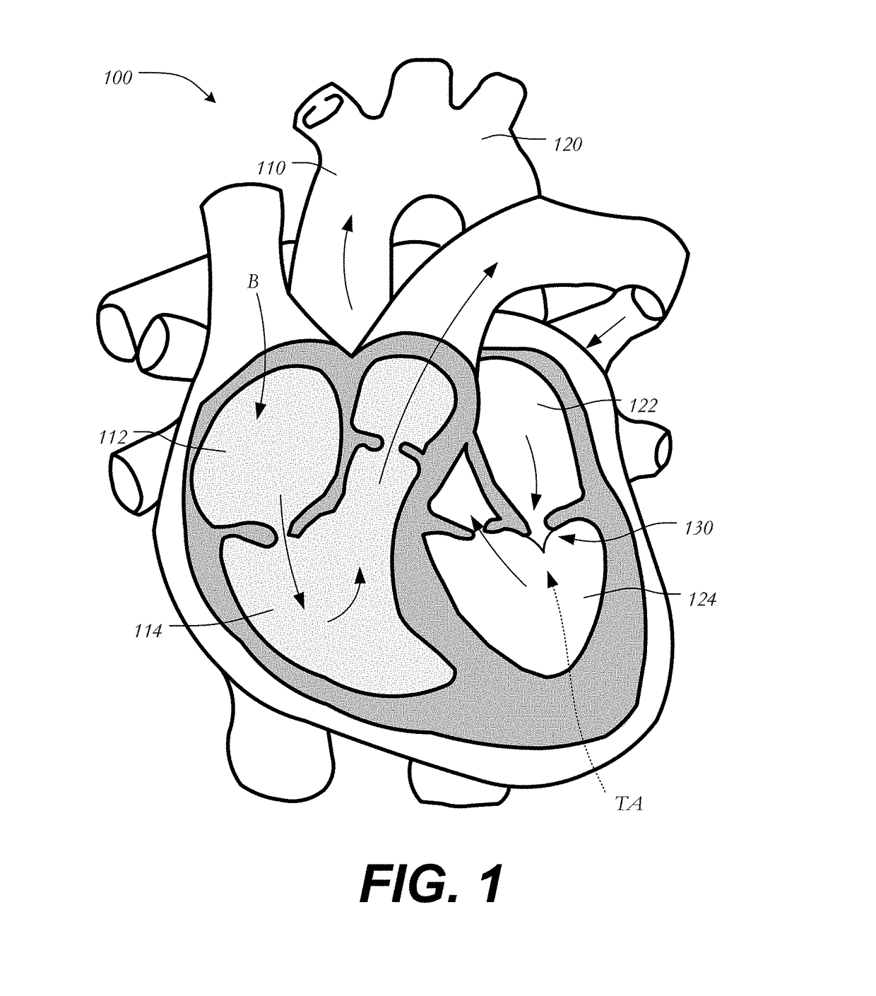 Transapical mitral valve replacement