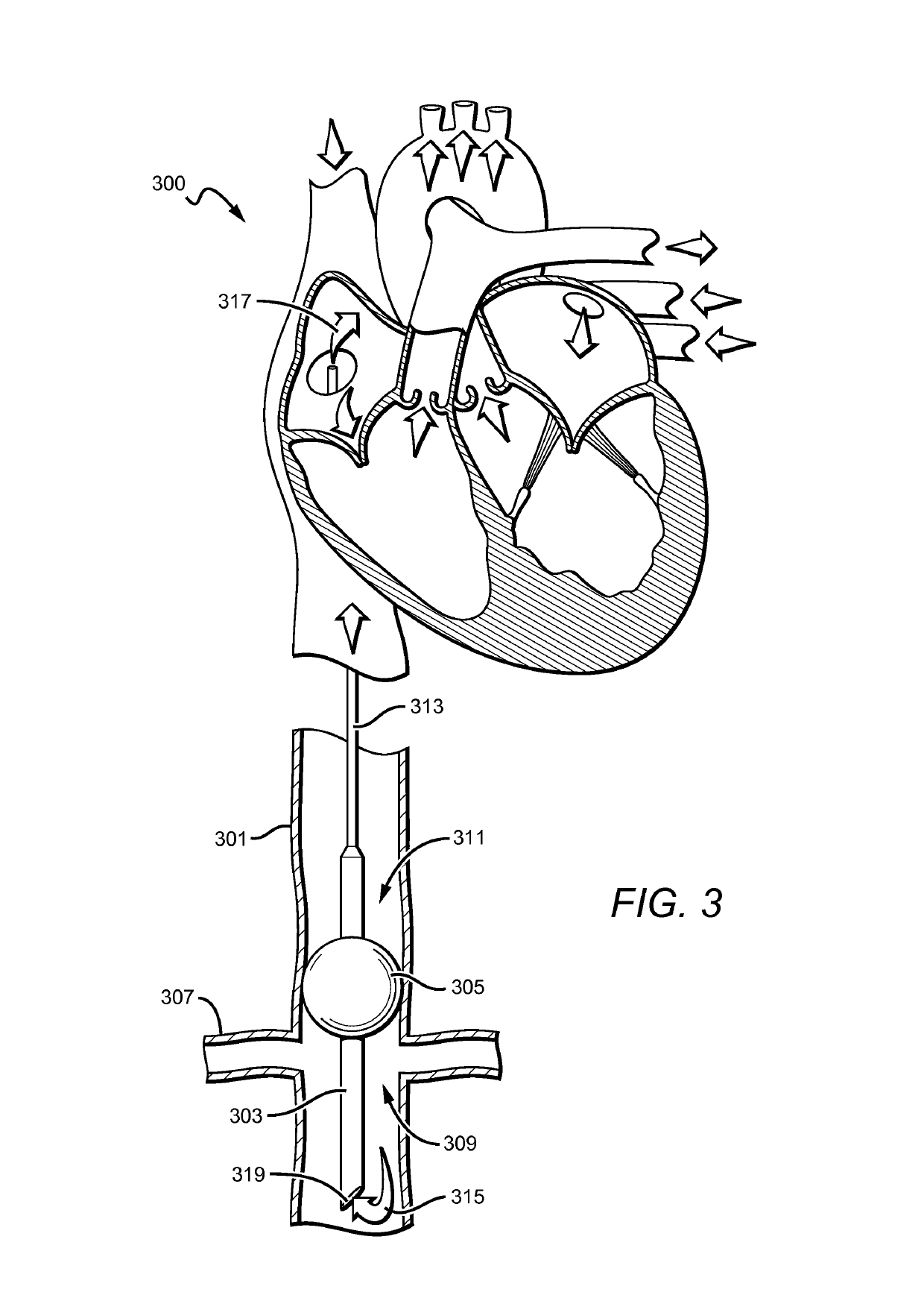 Catheter-based pump for improving organ function