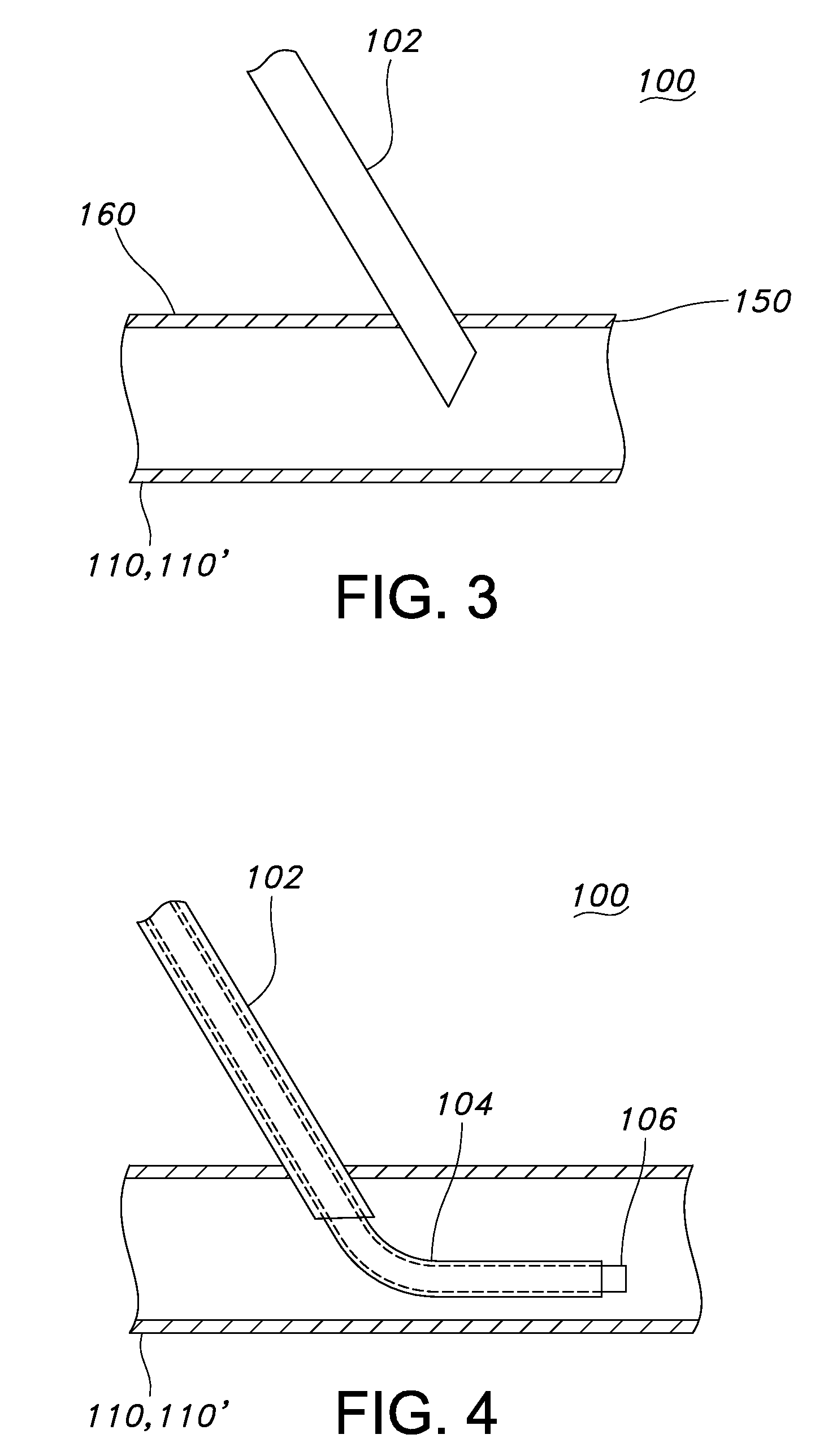 Expandable dialysis apparatus and method
