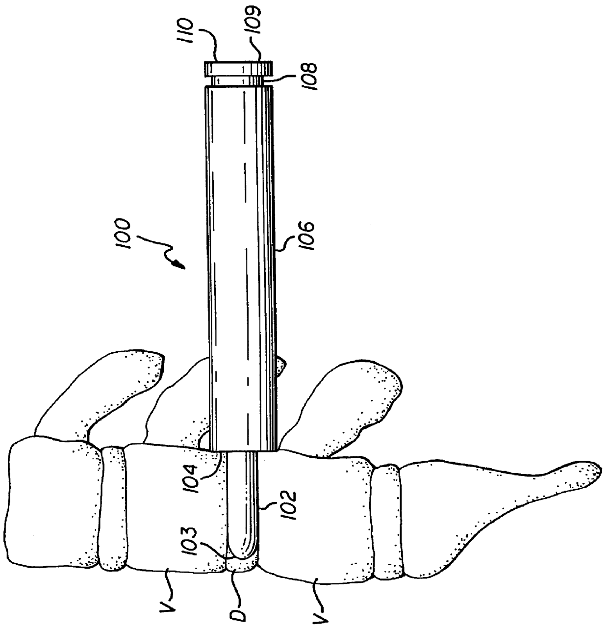 Apparatus for inserting spinal implants