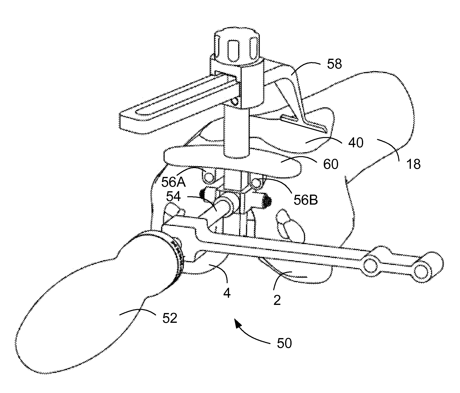 Methods And Apparatus For Preparing a Patient's Femur For Patellofemoral Knee Arthroplasty