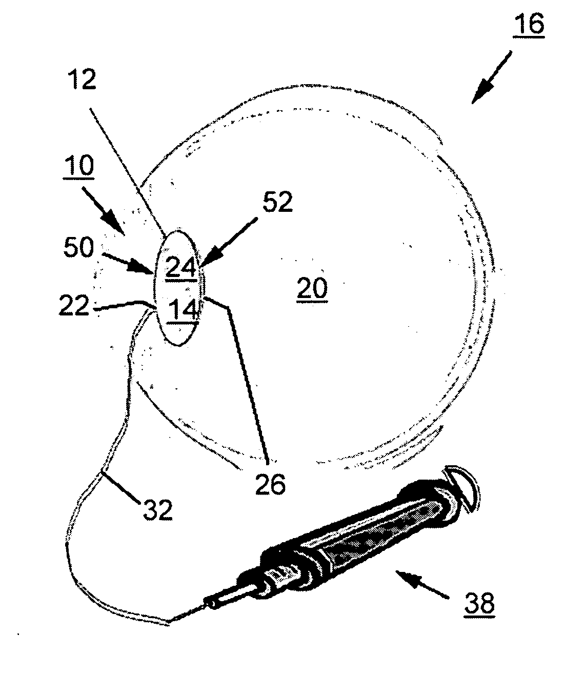 Eye implant and methods of positioning an artifical eye implant with the eye of a human or an animal