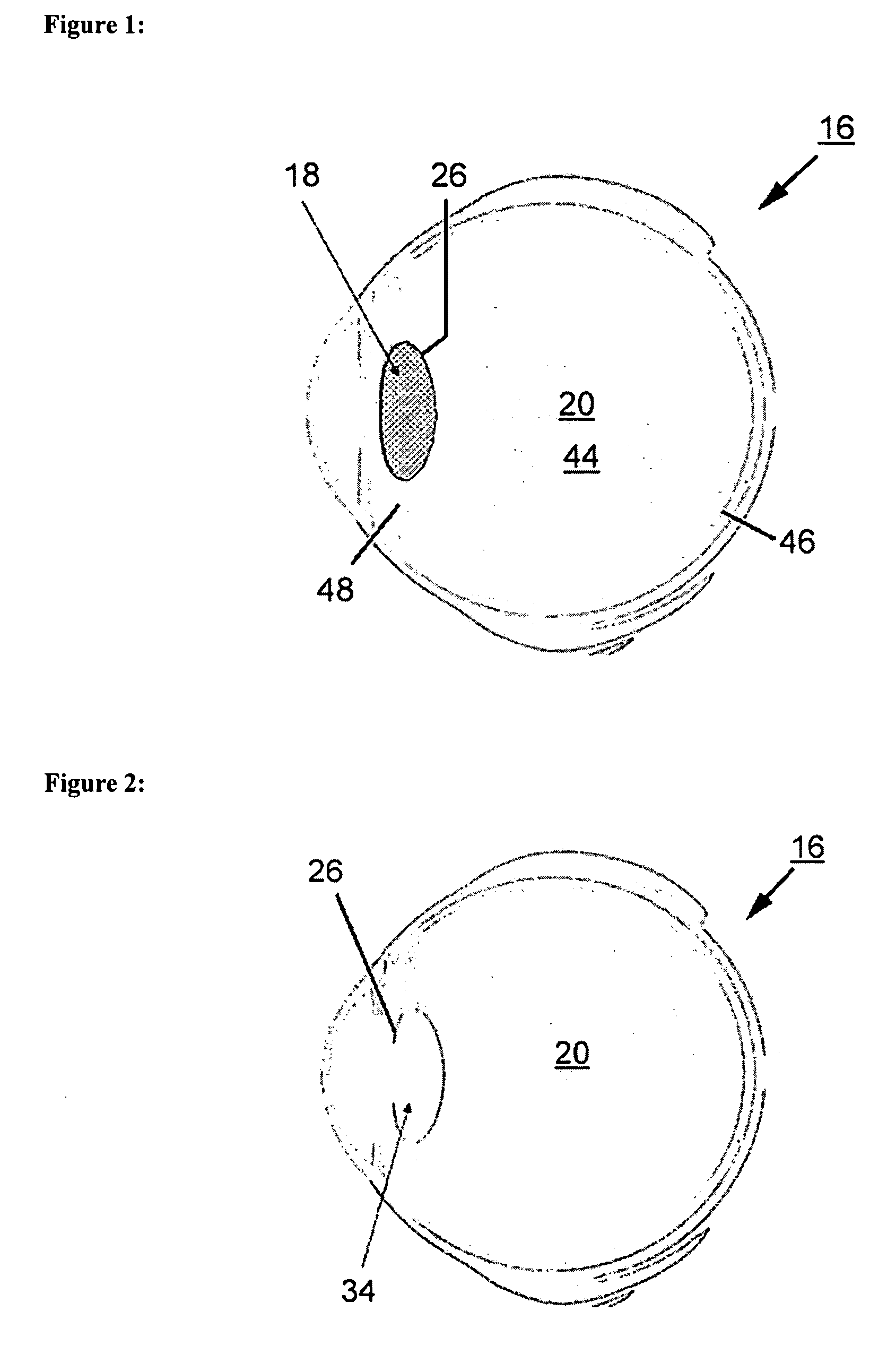Eye implant and methods of positioning an artifical eye implant with the eye of a human or an animal