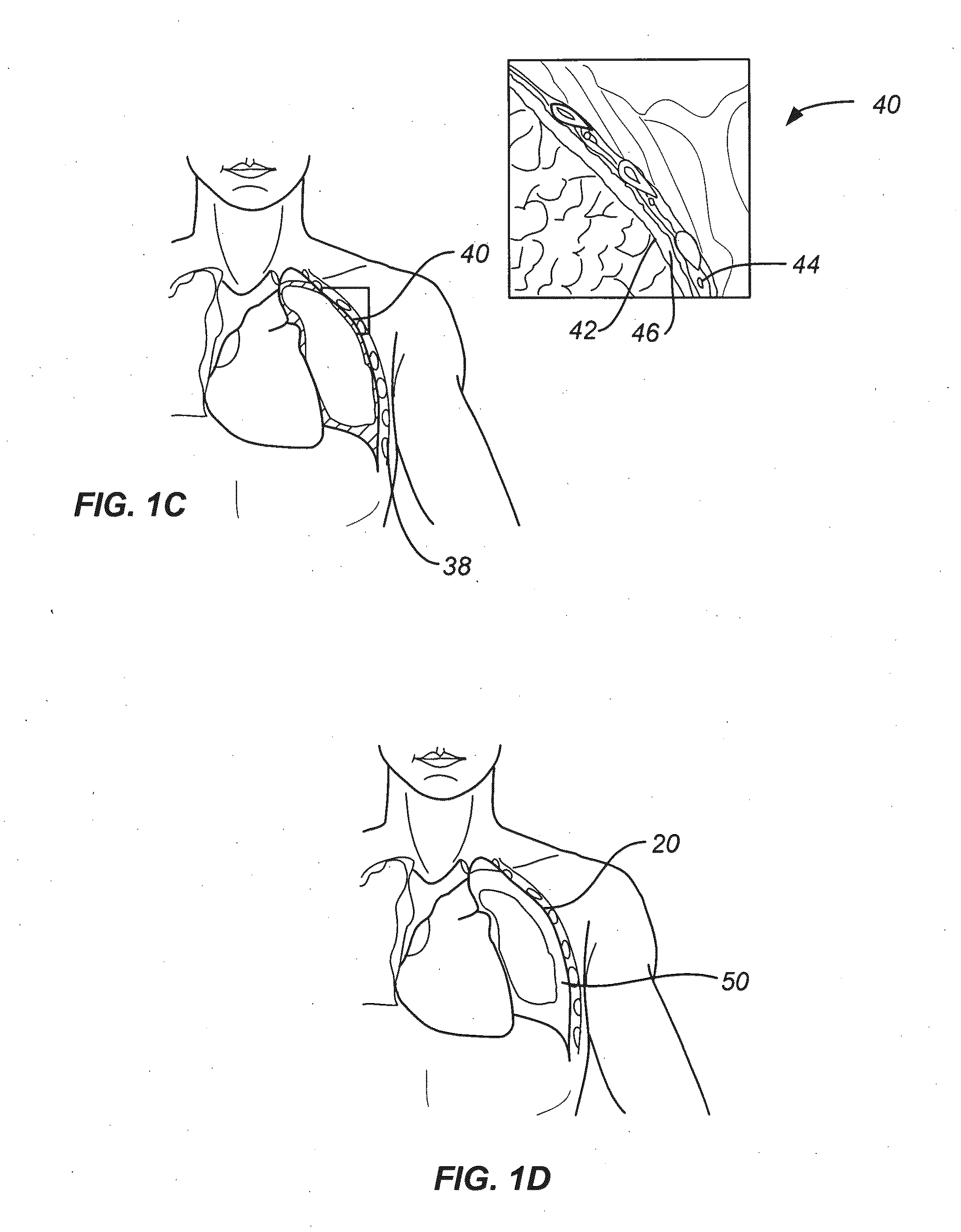 Steerable device for accessing a target site and methods