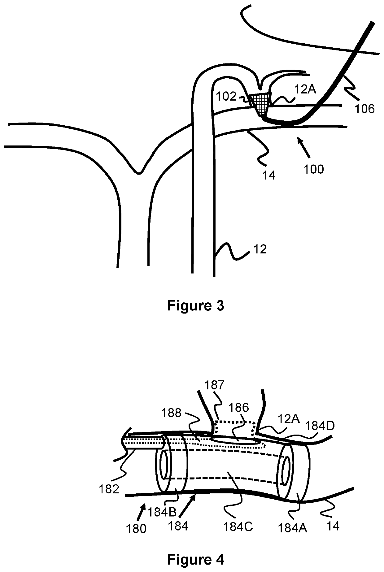 System And Method For Treatment Via Bodily Drainage Or Injection