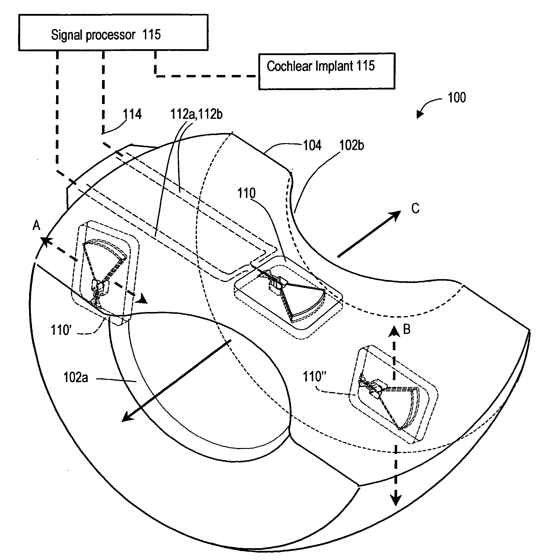 Hearing implant with MEMS inertial sensor and method of use
