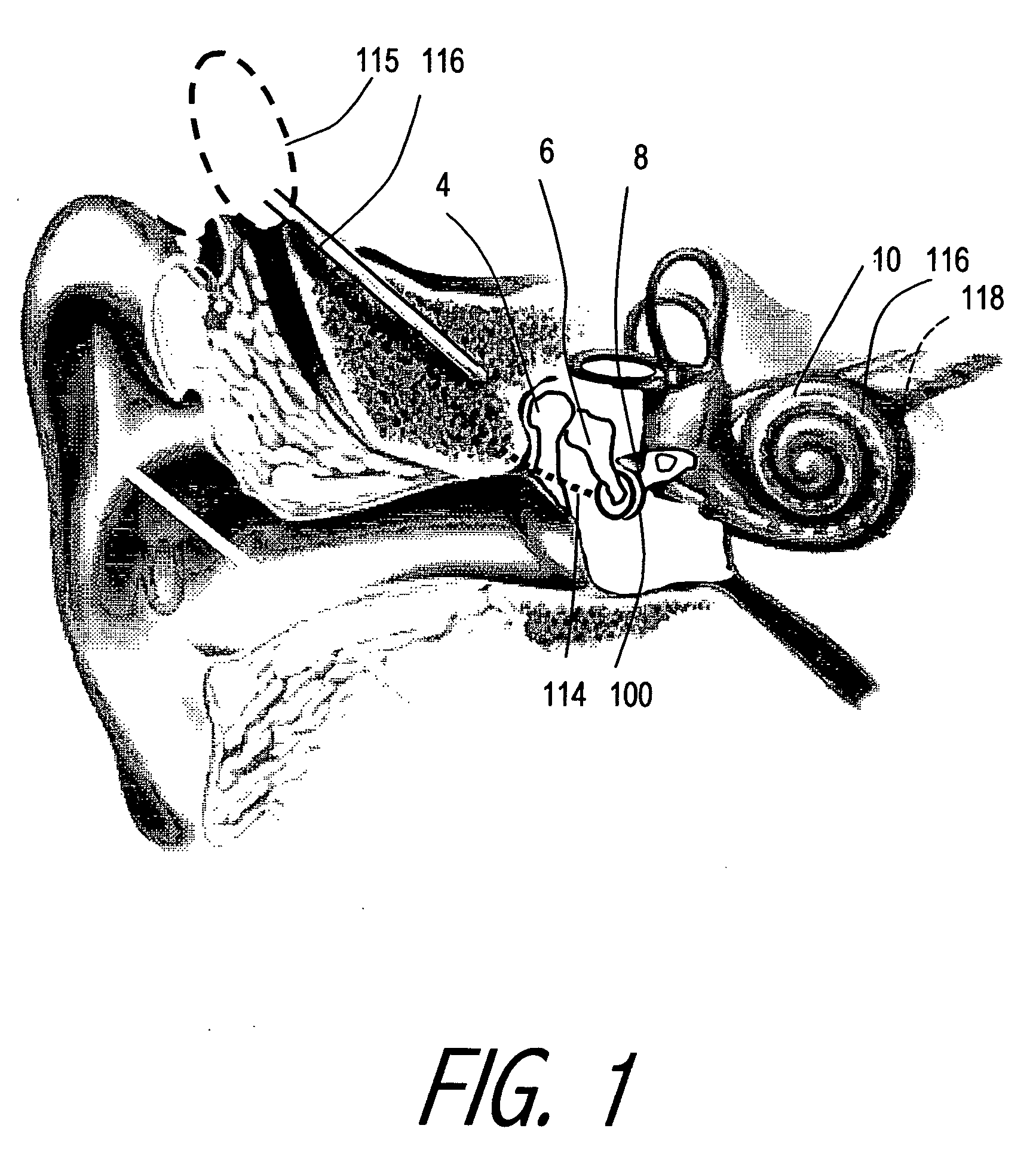 Hearing implant with MEMS inertial sensor and method of use