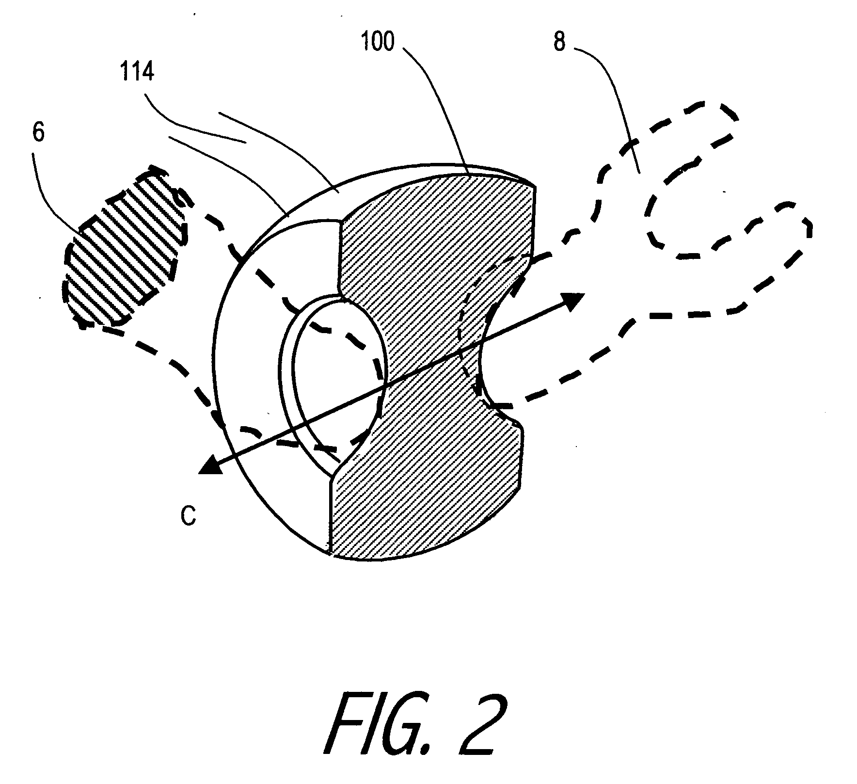 Hearing implant with MEMS inertial sensor and method of use