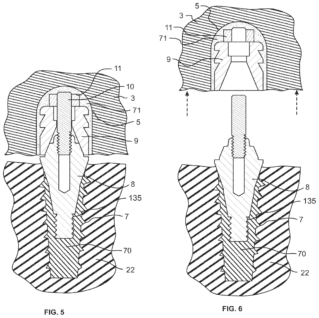 Screw-attached pick-up dental coping system and methods