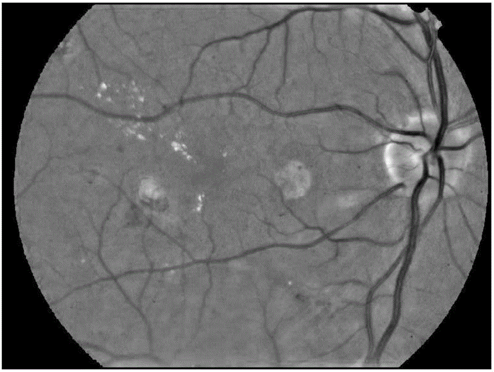 Gradient vector analysis-based retinal image micro-aneurysm automatic detection and identification method