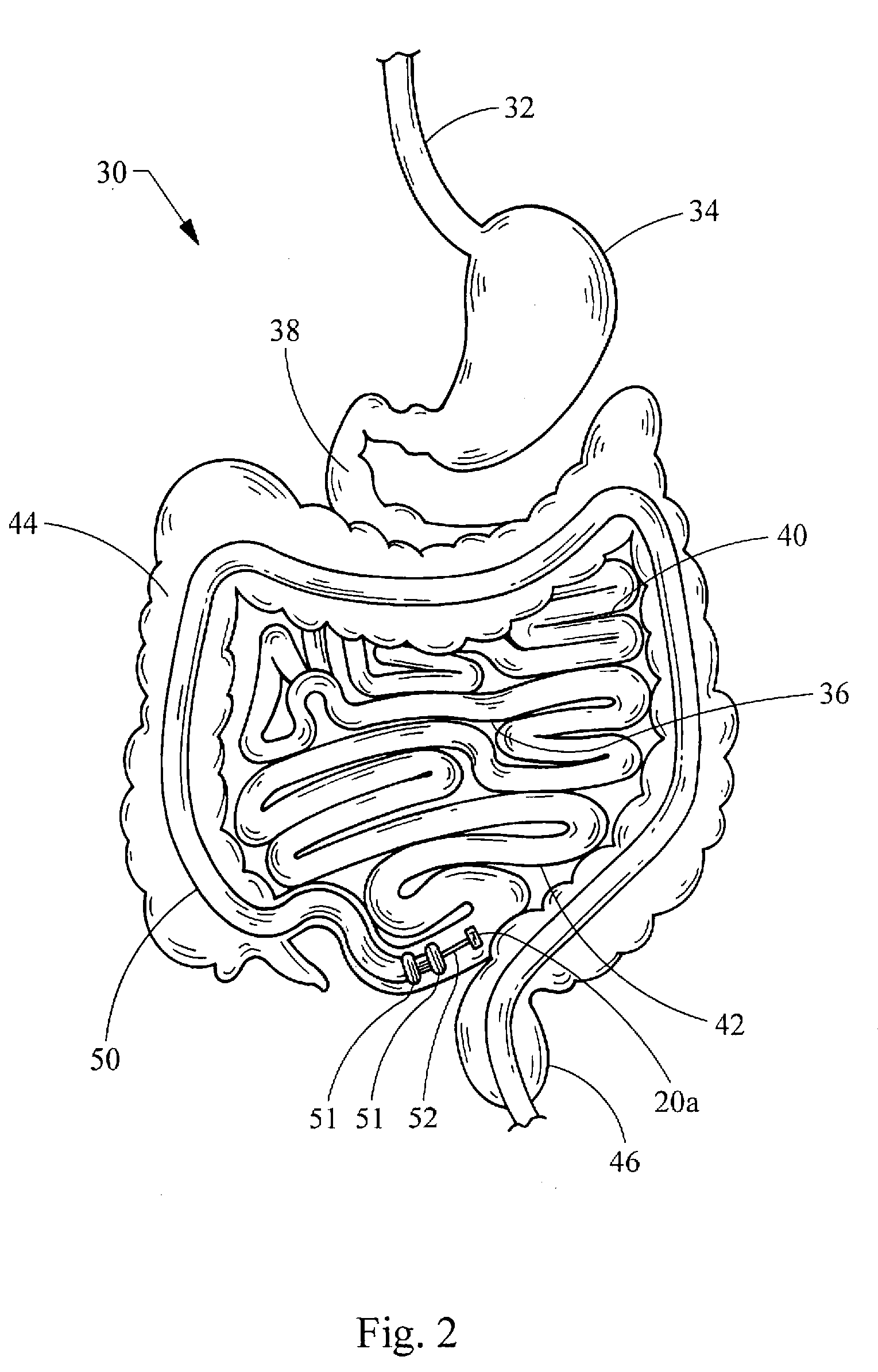 Intestinal bypass using magnets