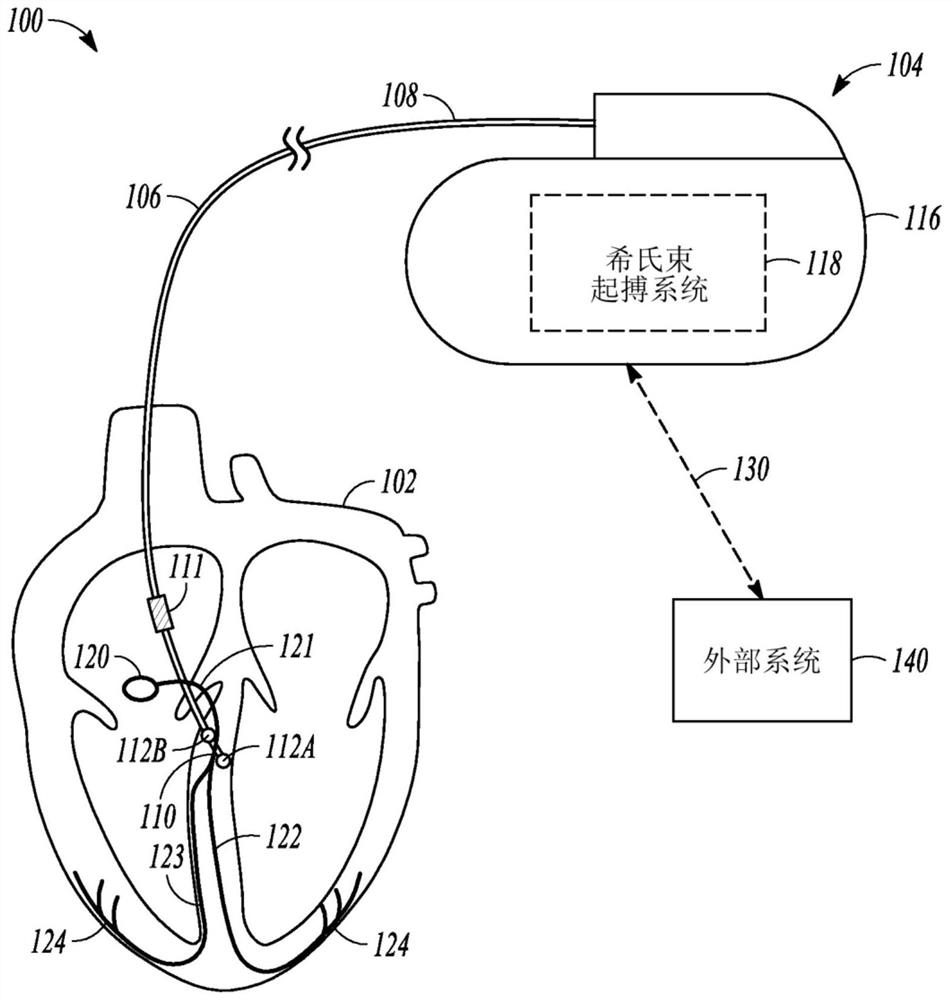 Adjustable sensing in a his-bundle pacemaker