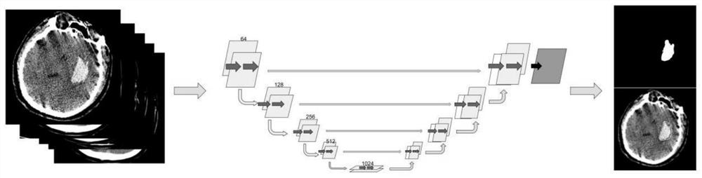 Intracranial hemorrhage automatic sketching method and device based on head CT (Computed Tomography) plain-scan image