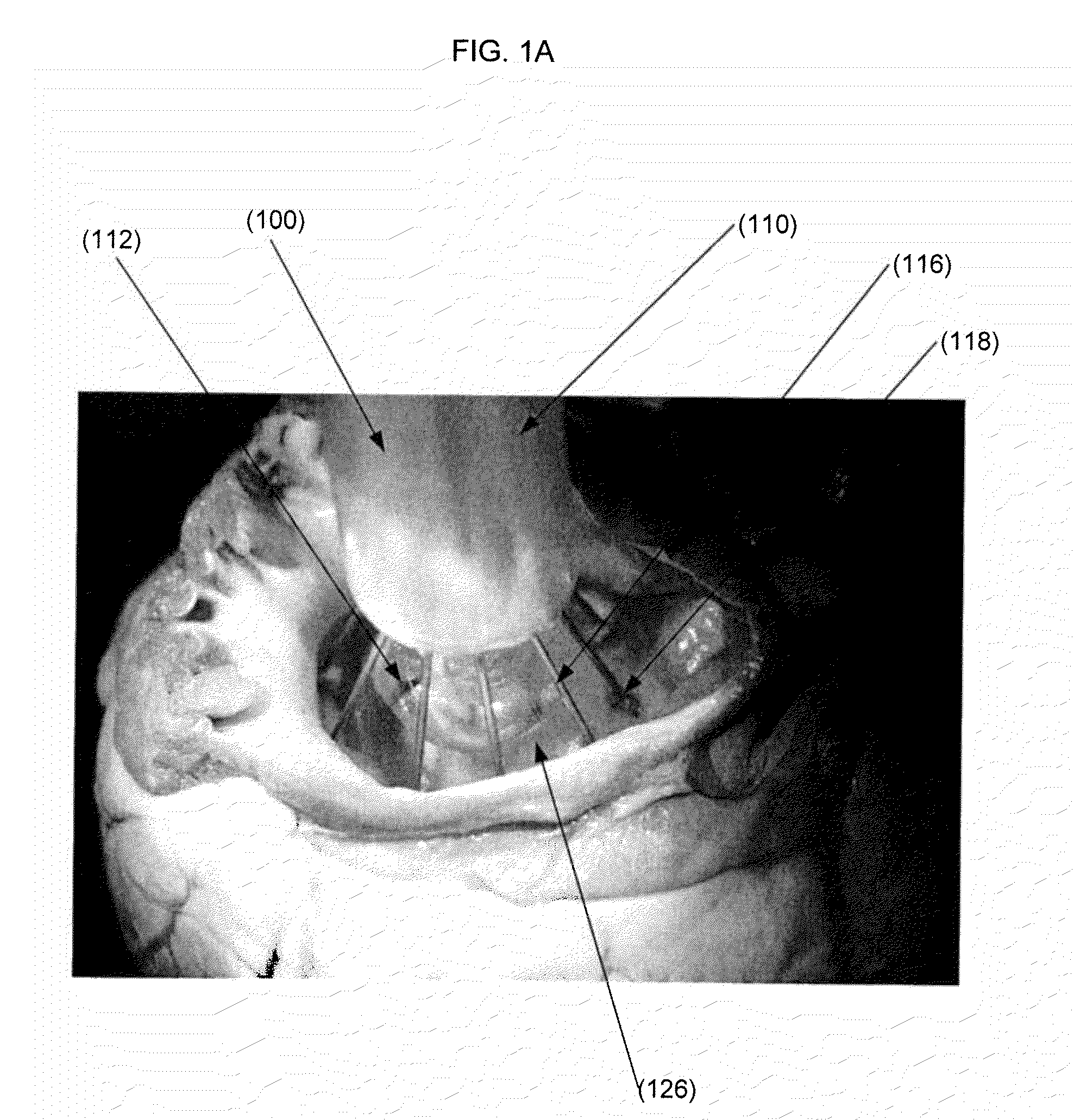 Inflatable minimally invasive system for delivering and securing an annular implant