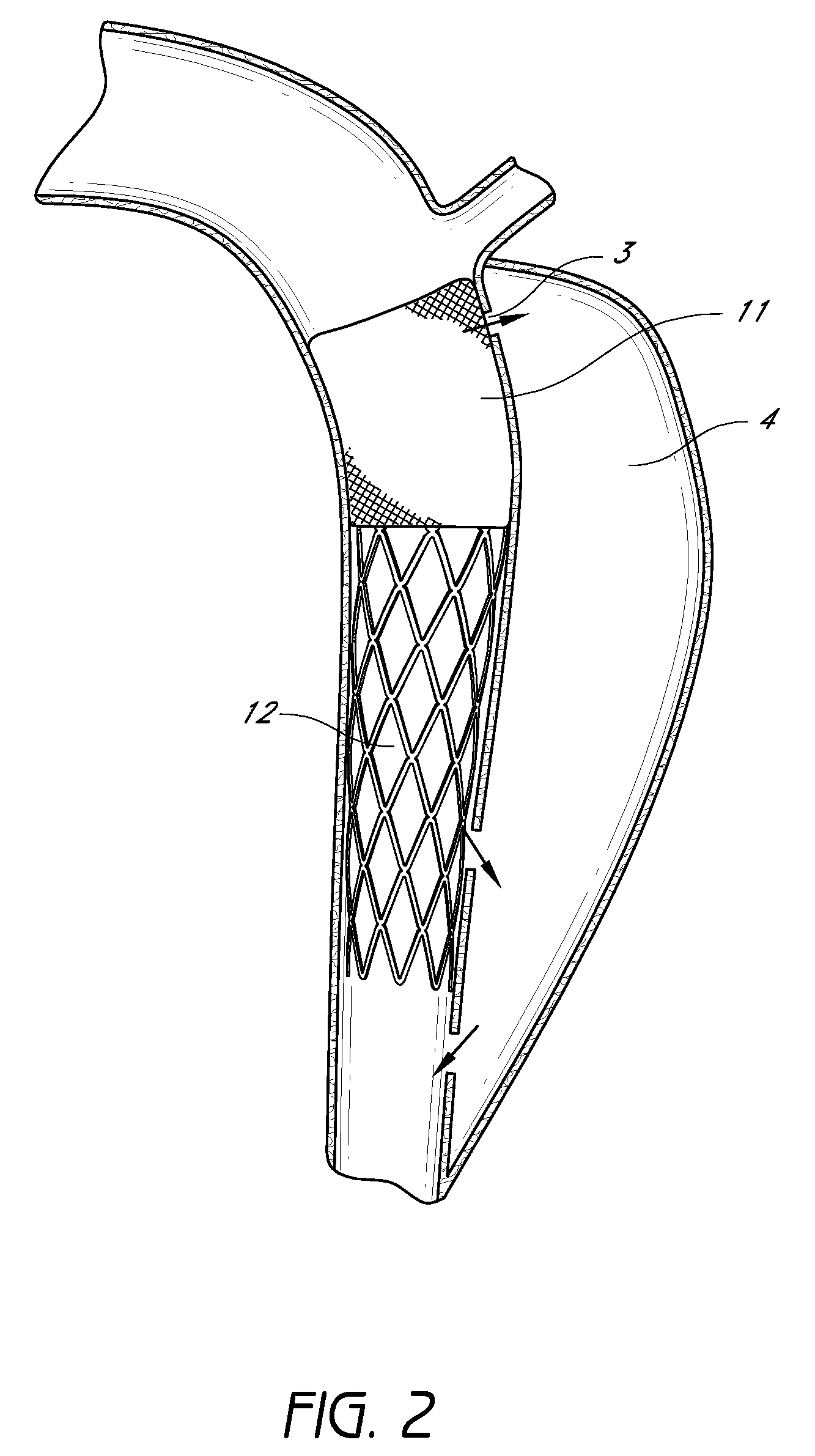 Devices and methods to treat vascular dissections