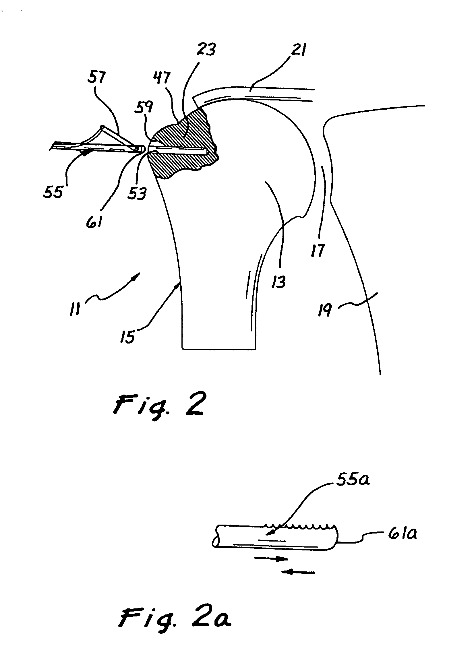 Methods for attaching connective tissues to bone using a multi-component bone anchor