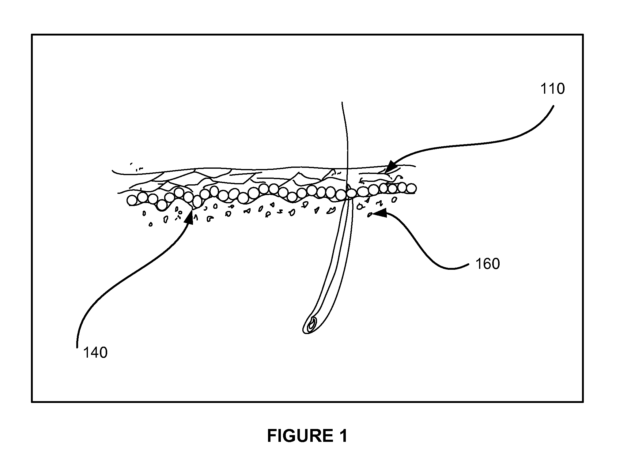 Device and Method of Minimally Invasive Tattooing and Tattoo Removal
