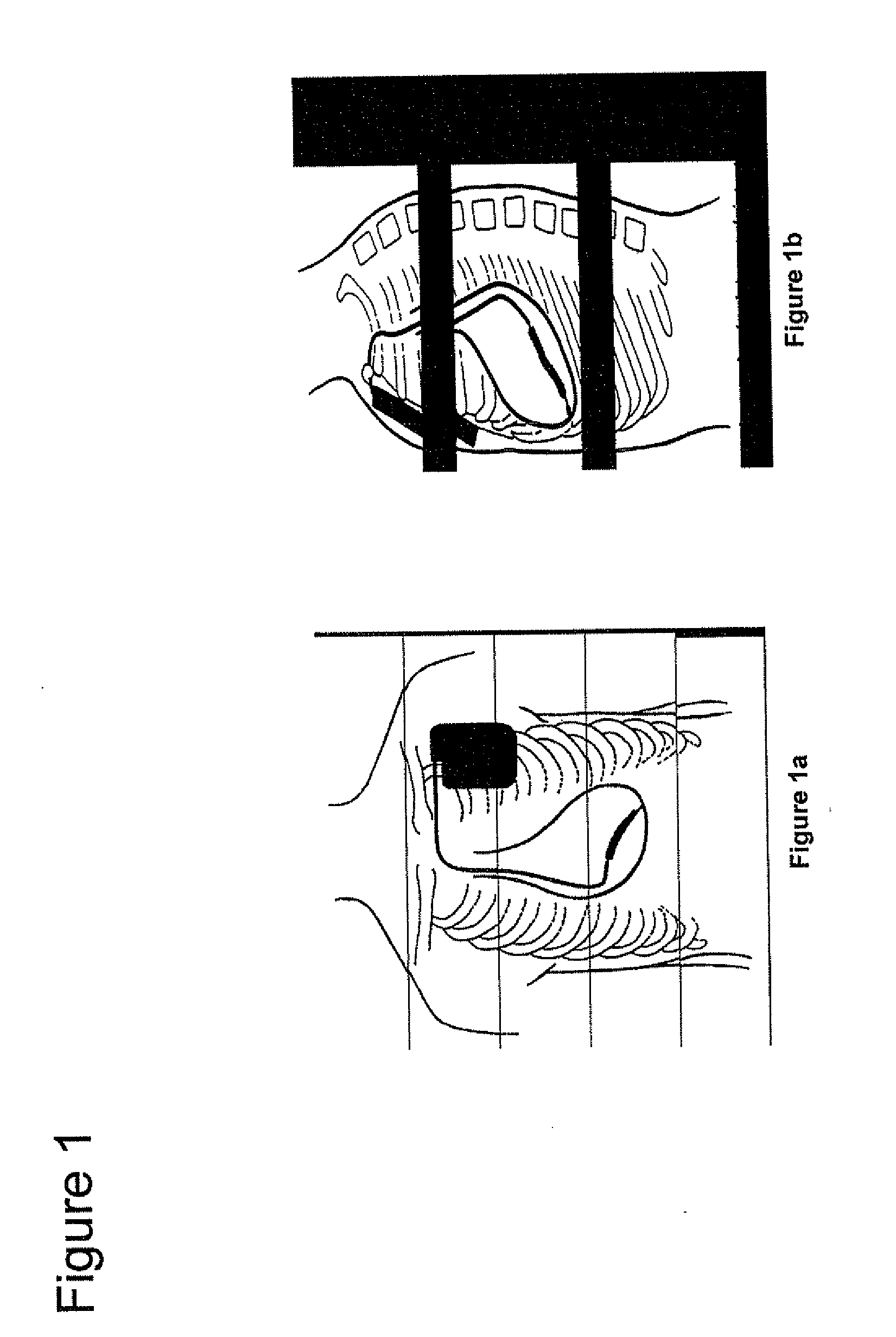 Method and apparatus for detection and treatment of autonomic system imbalance
