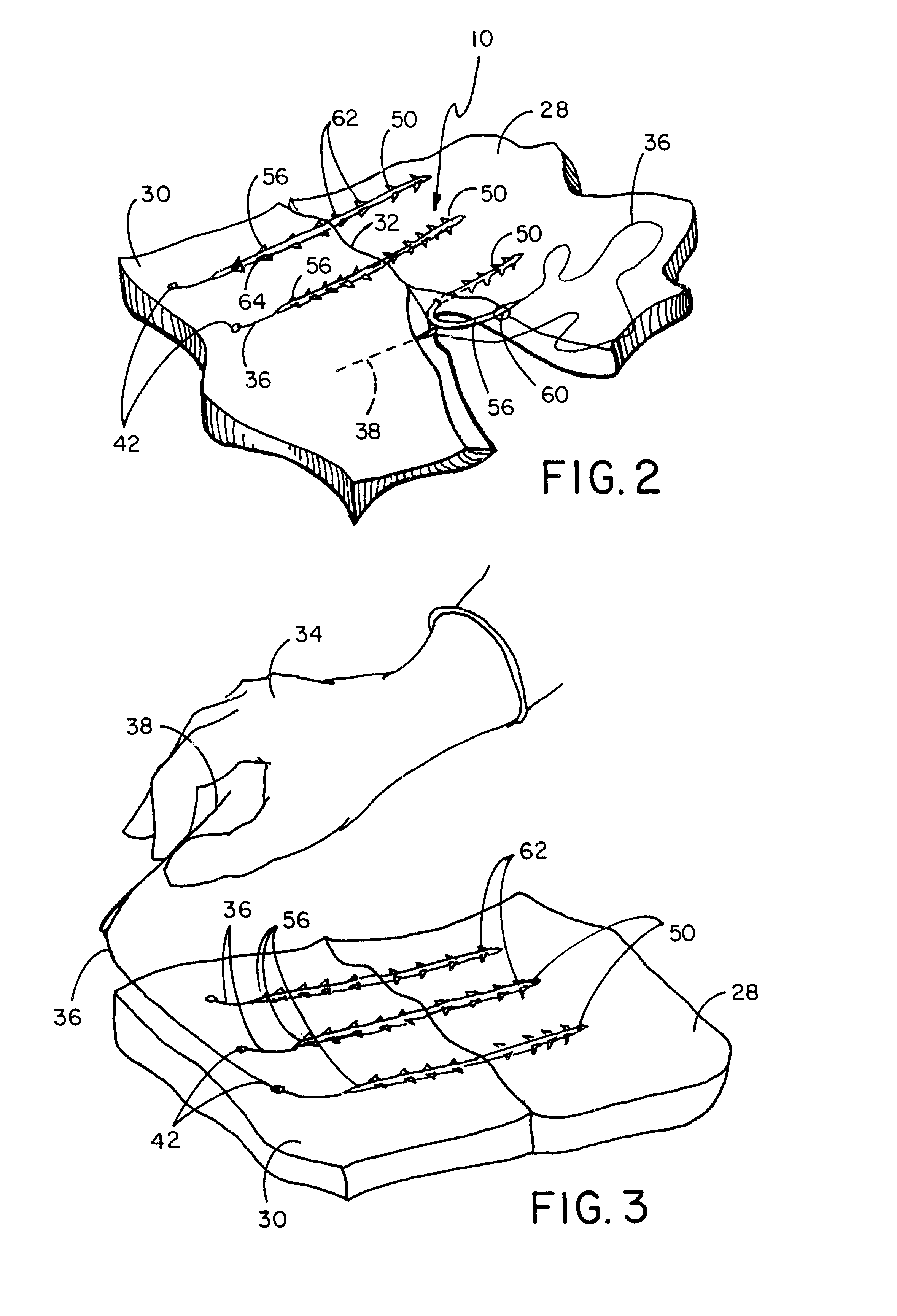 Suture and method of use