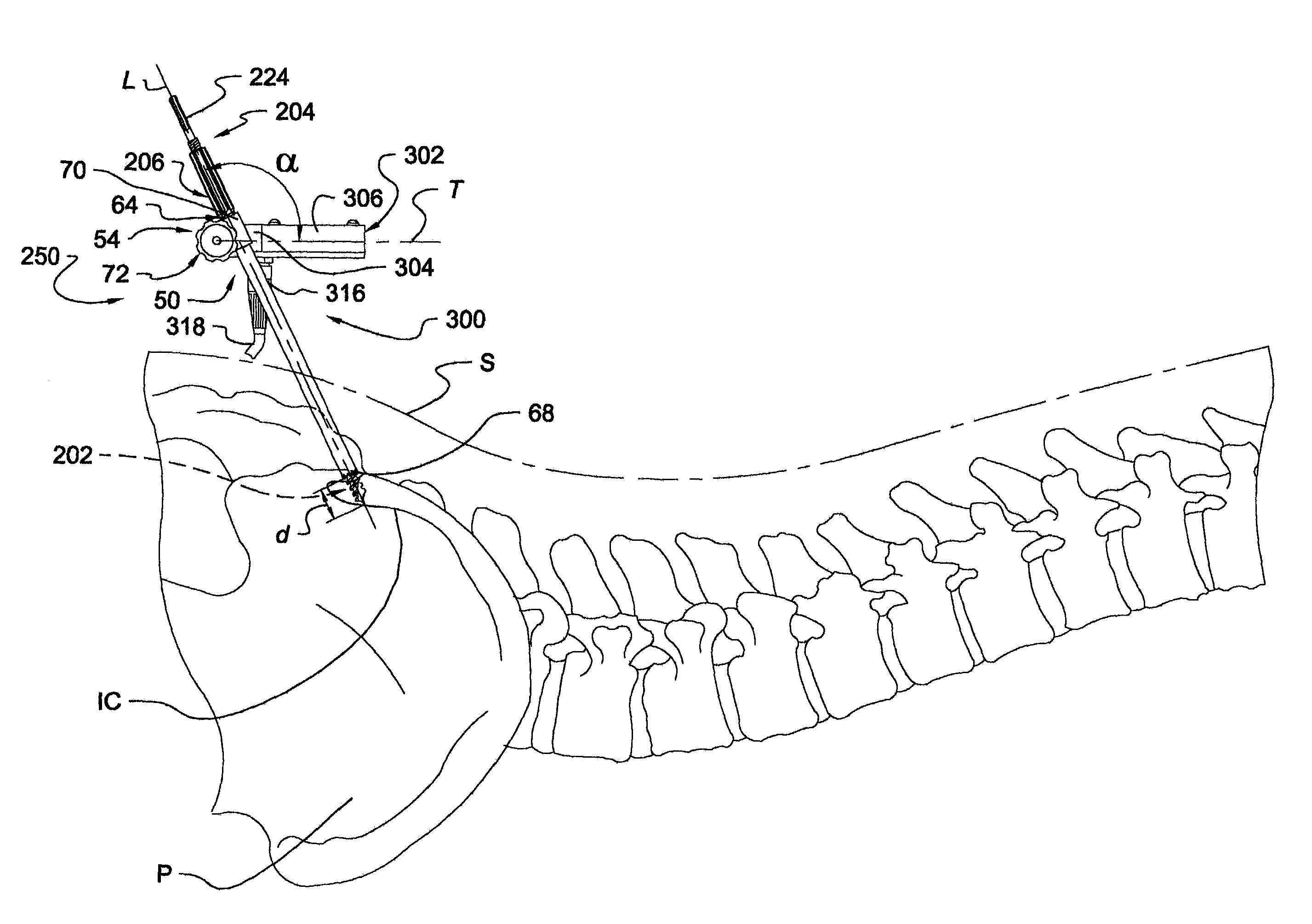 Instrumentation and method for mounting a surgical navigation reference device to a patient