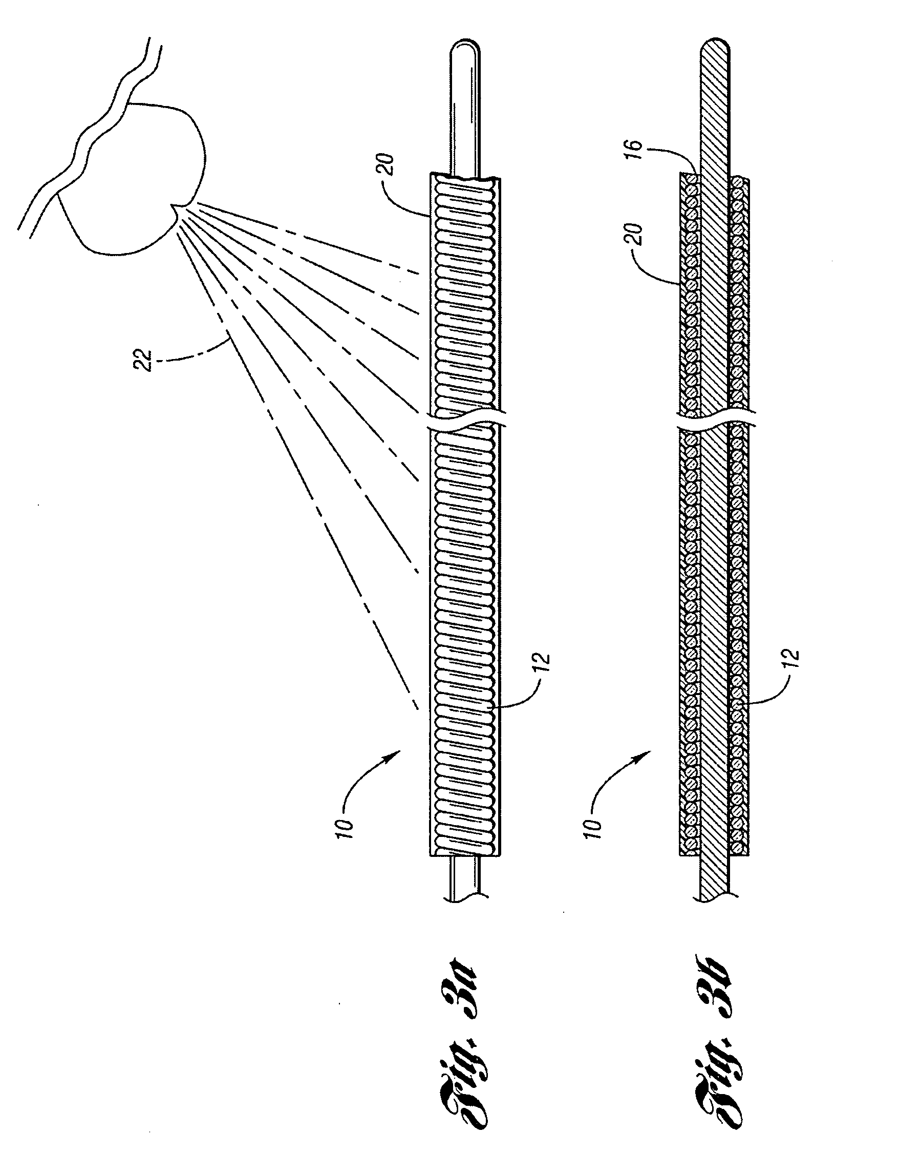 Occluding device for occlusion of a body vessel and method for making the same