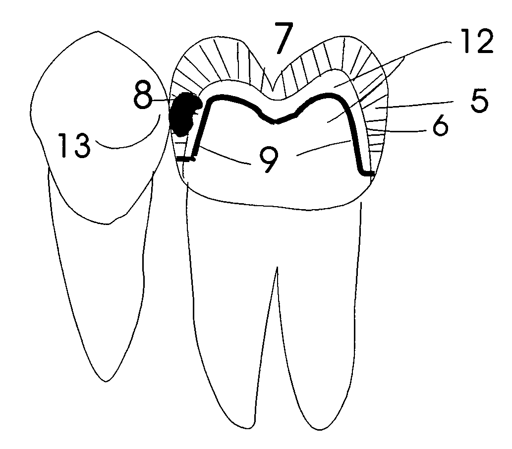 Dental insert and method of tooth restoration