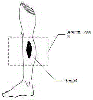Digital image processing method for varicose vein of lower limb