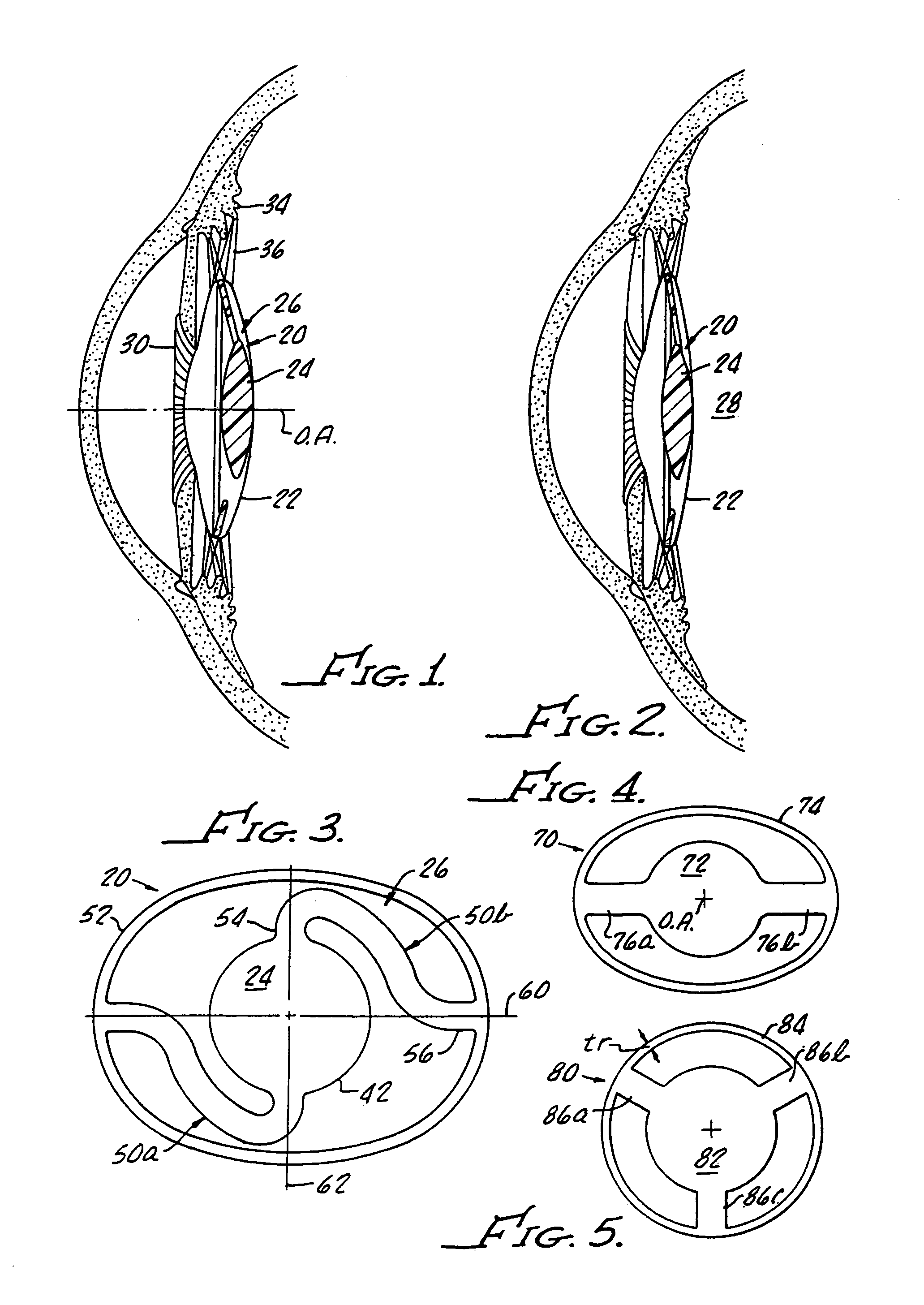 Accommodating intraocular lens with integral capsular bag ring