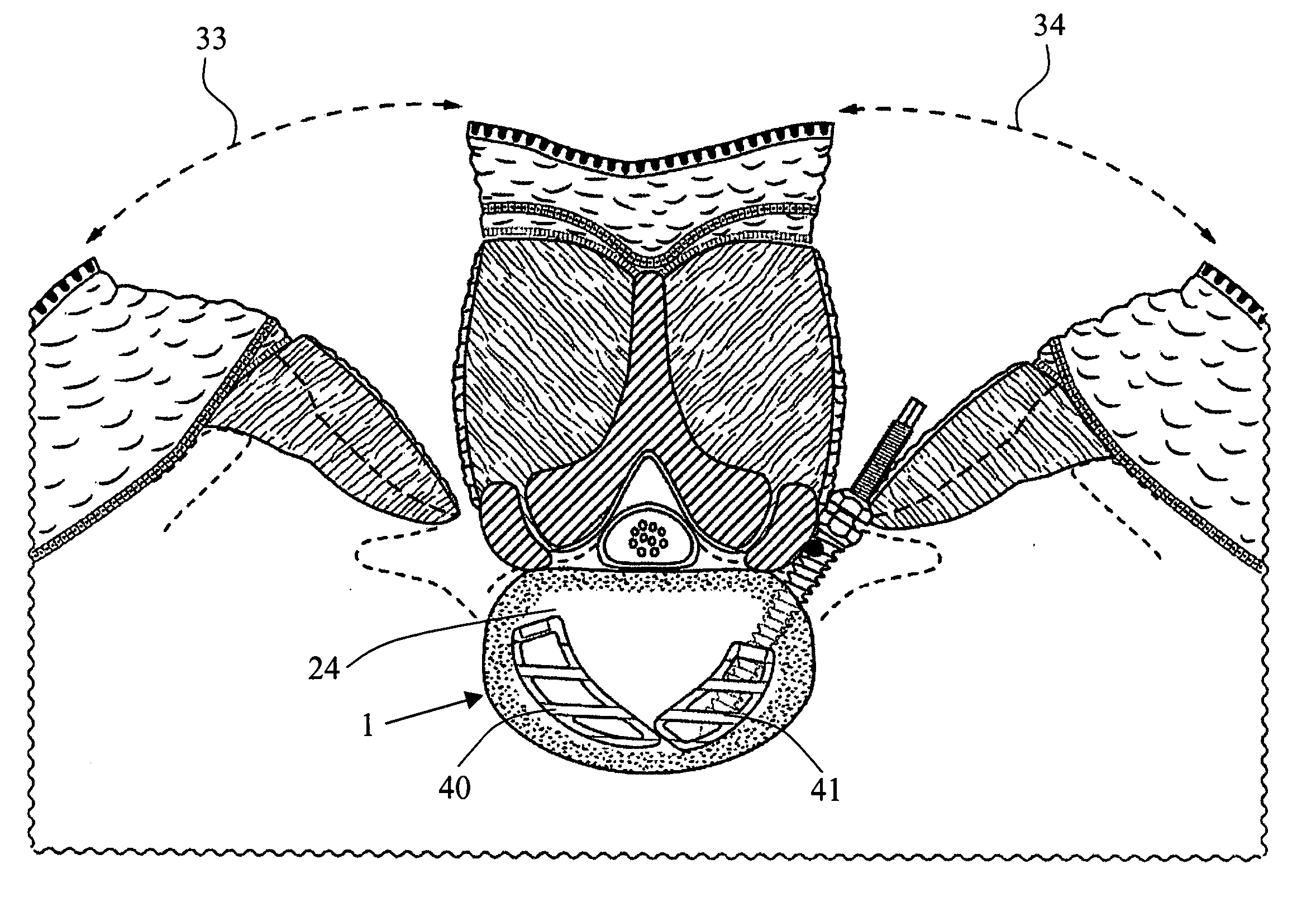 Method for repair of a spine and intervertebral implant