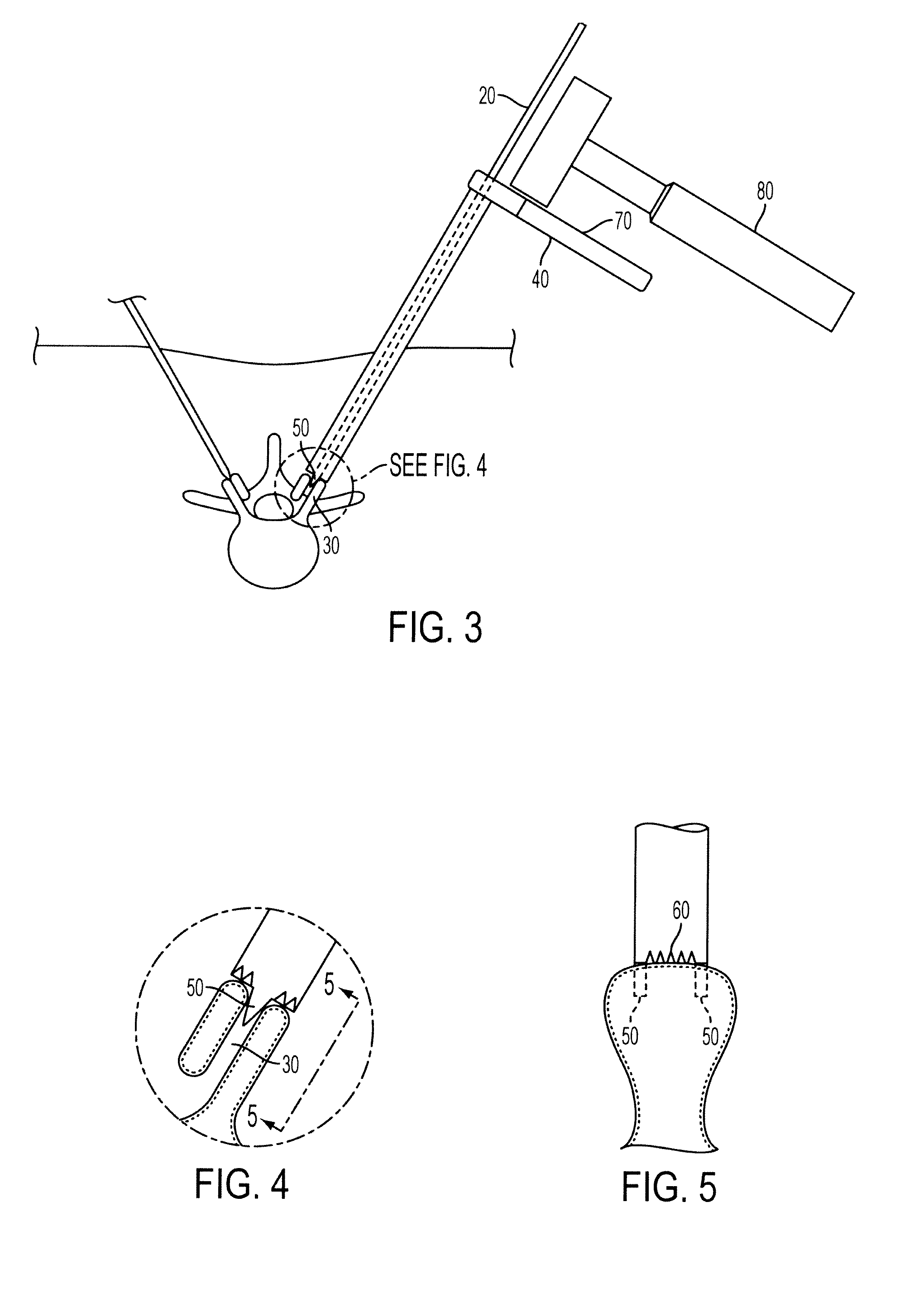 Methods and surgical kits for minimally-invasive facet joint fusion